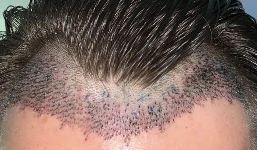 Shedding After Hair Transplant | Treatment Rooms London