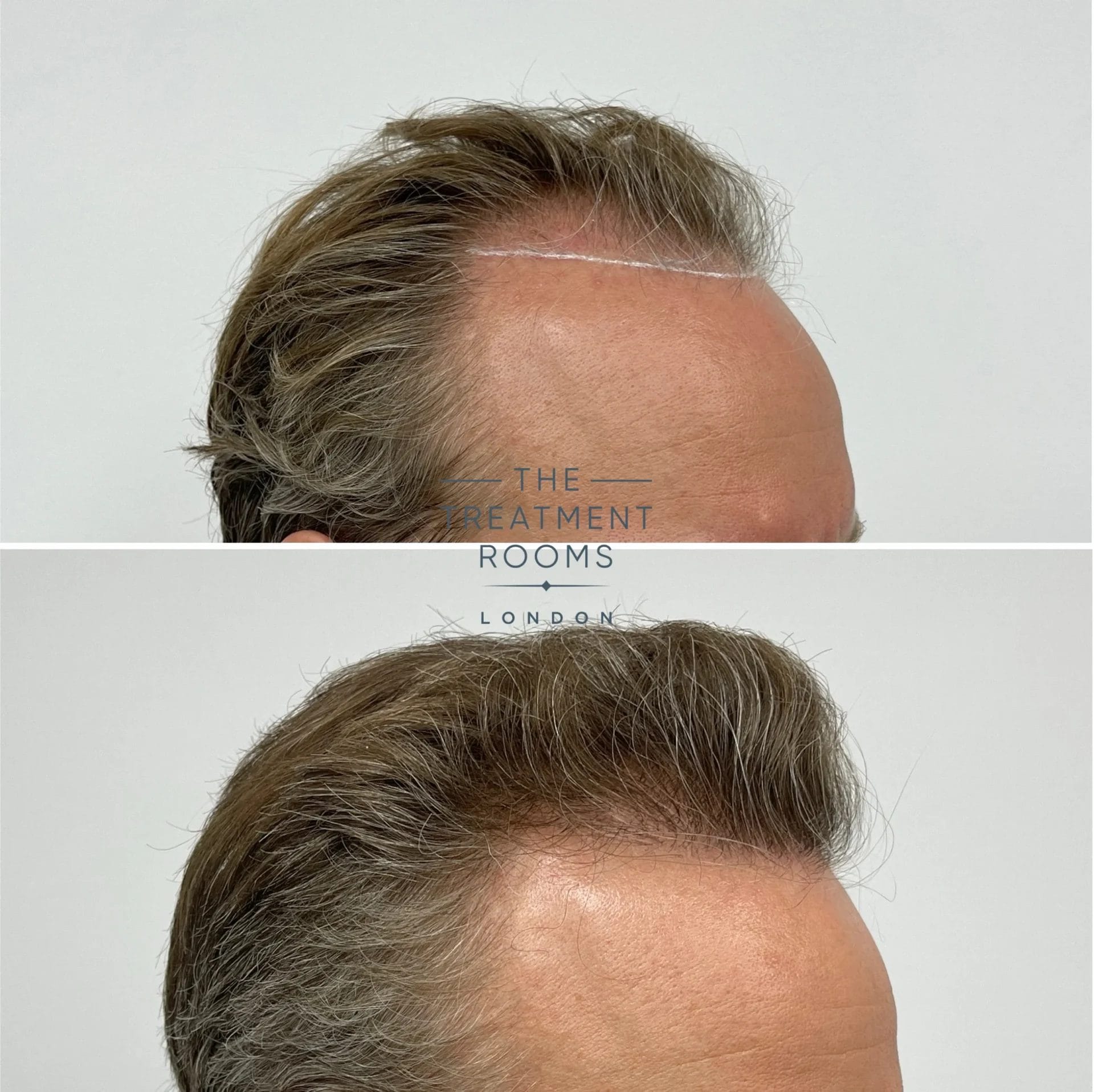 hair transplant 2278 grafts before and after
