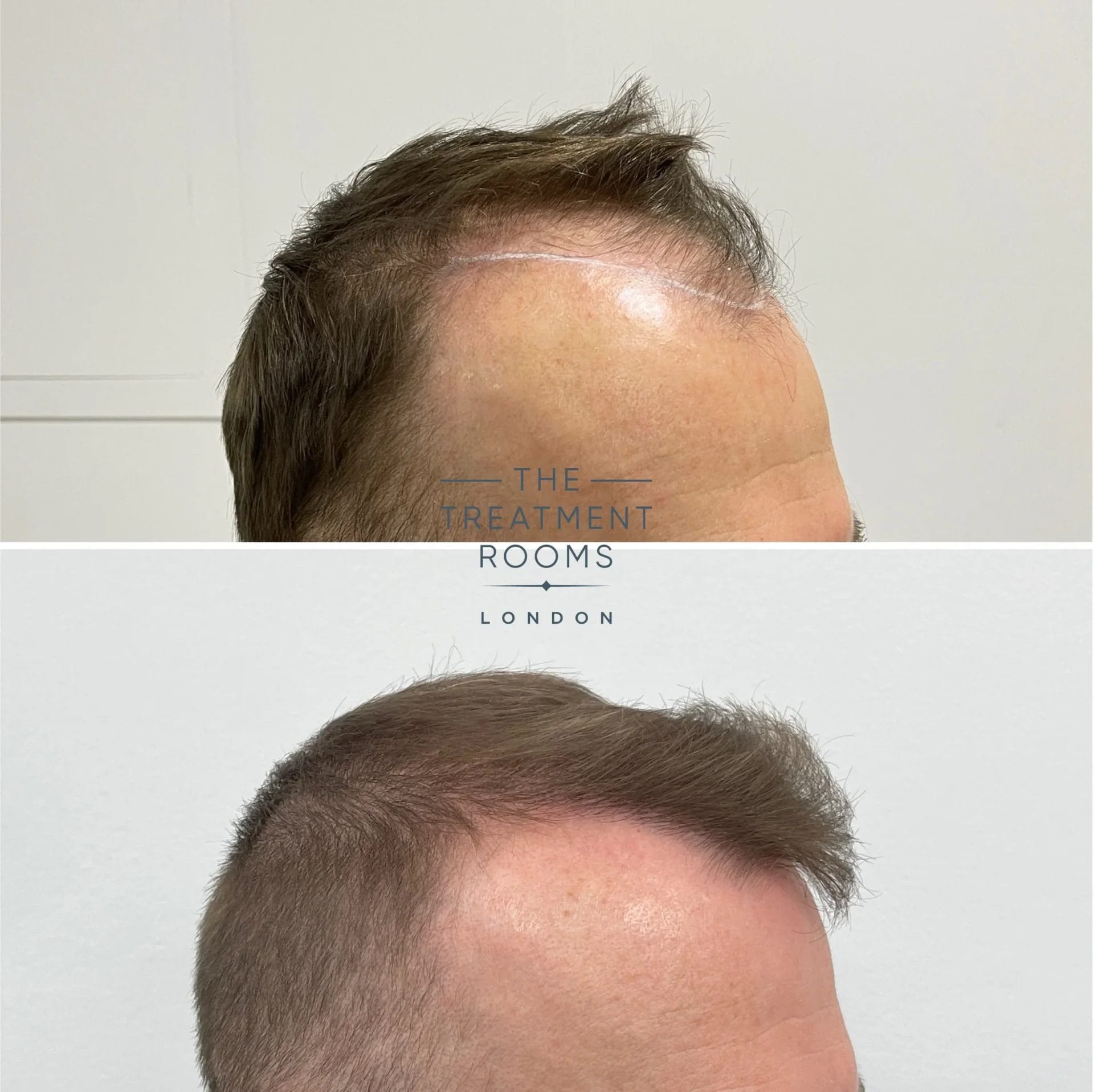 hair transplant before and after 1592 grafts