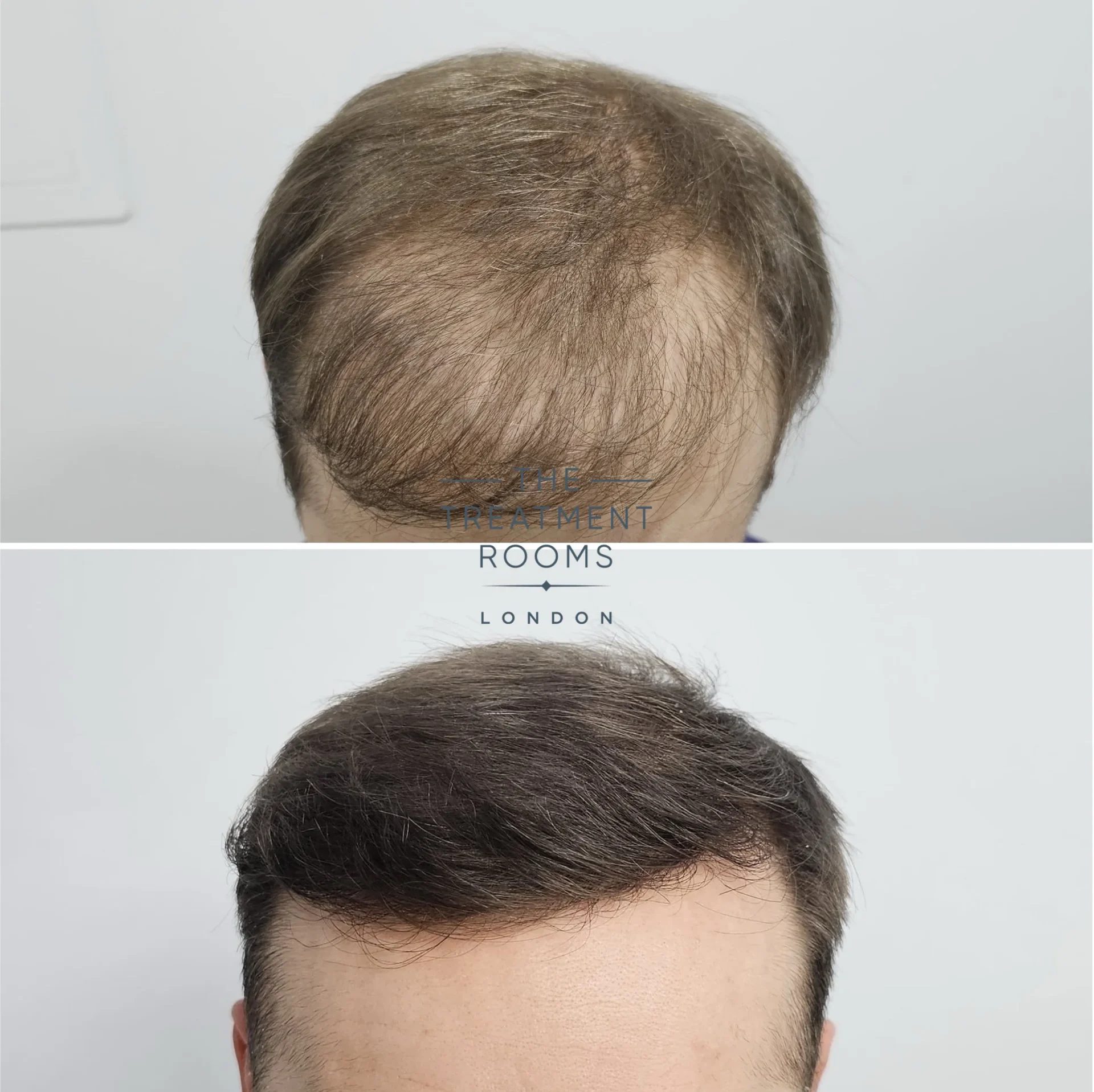hair transplant before and after 1733 grafts repair surgery