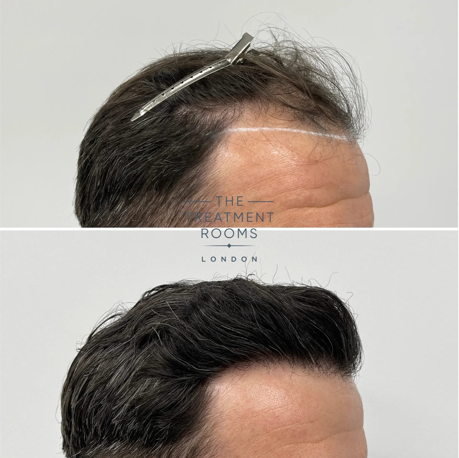 hair transplant before and after 1868 grafts