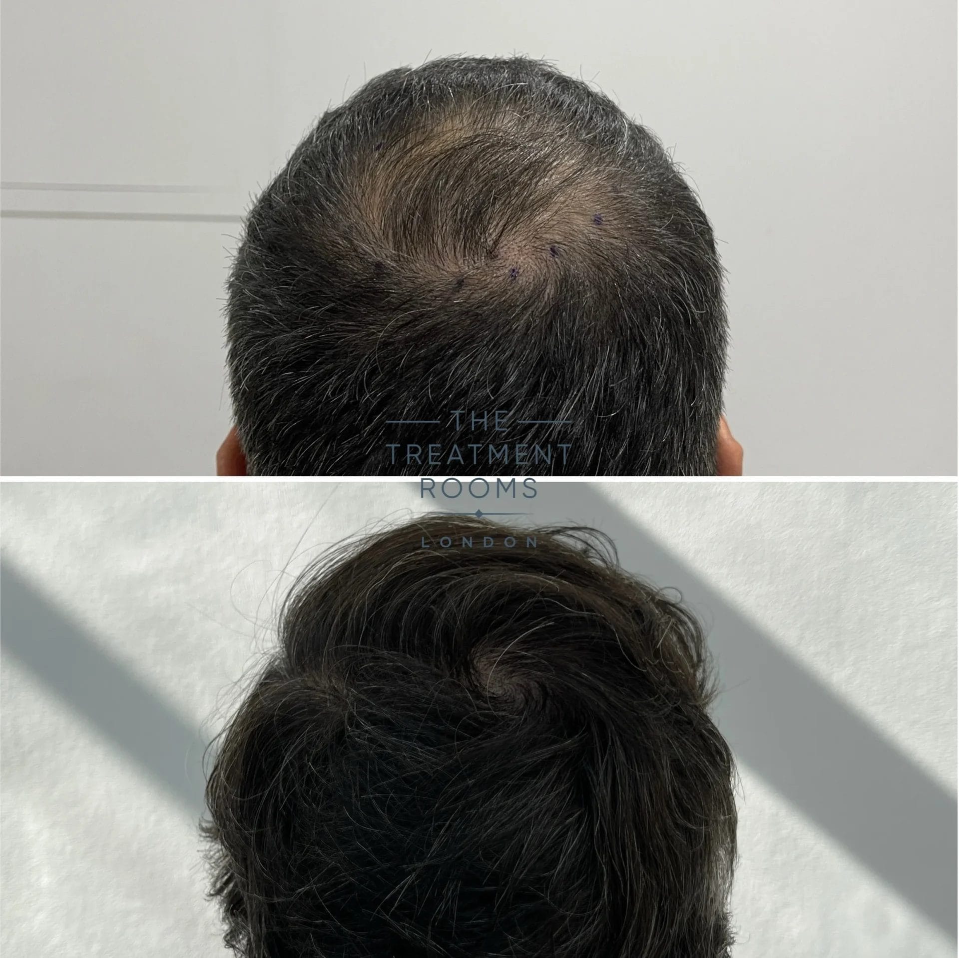 hair transplant before and after 2239 grafts crown