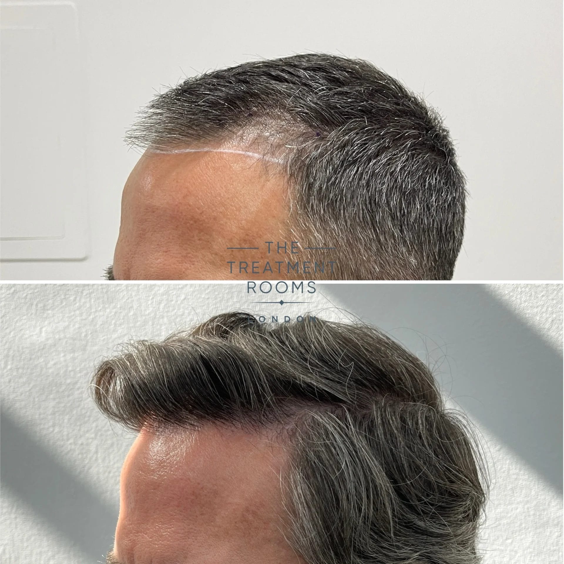 hair transplant before and after 2239 grafts receding hairline