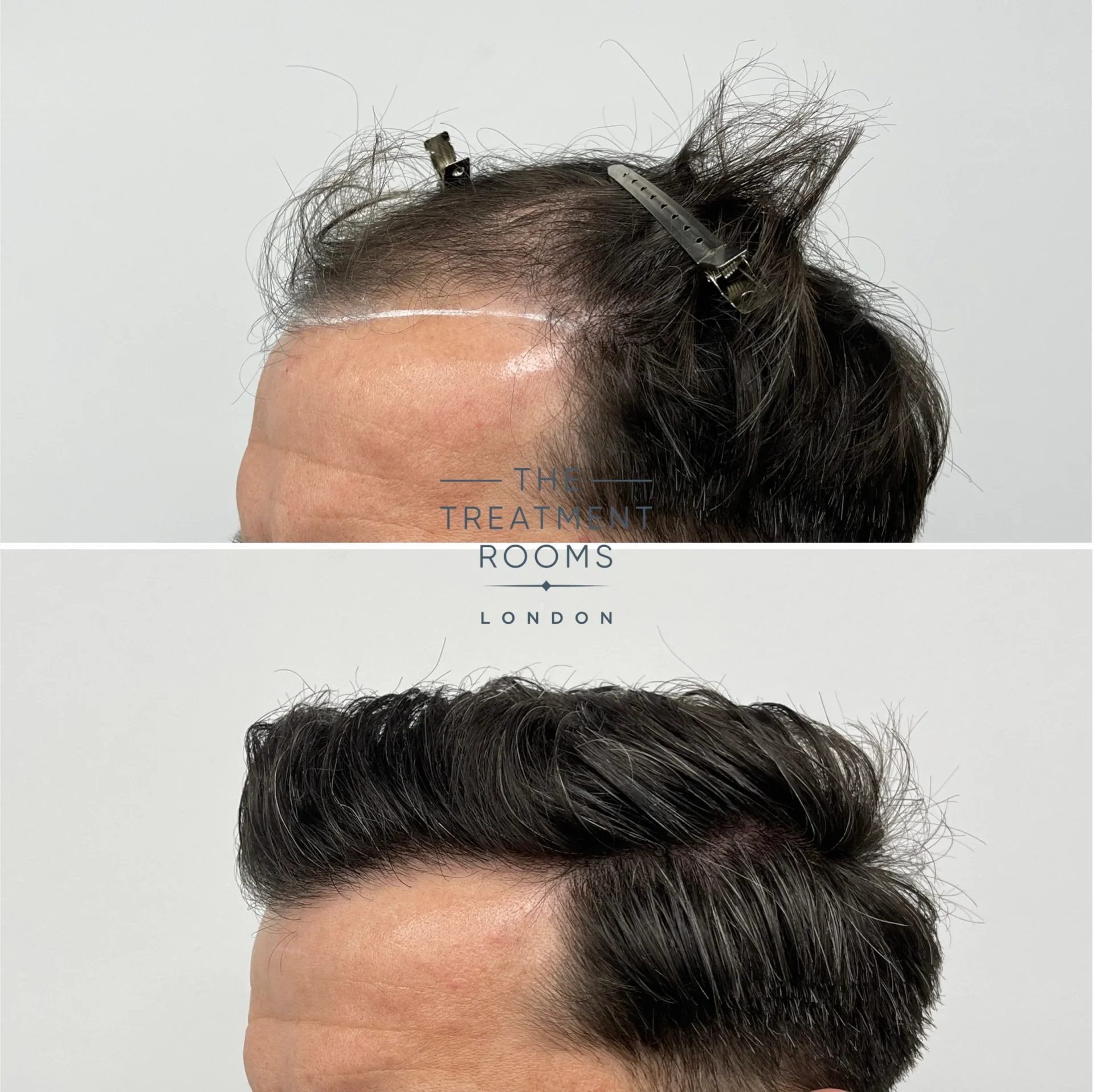 hair transplant for receding hairline