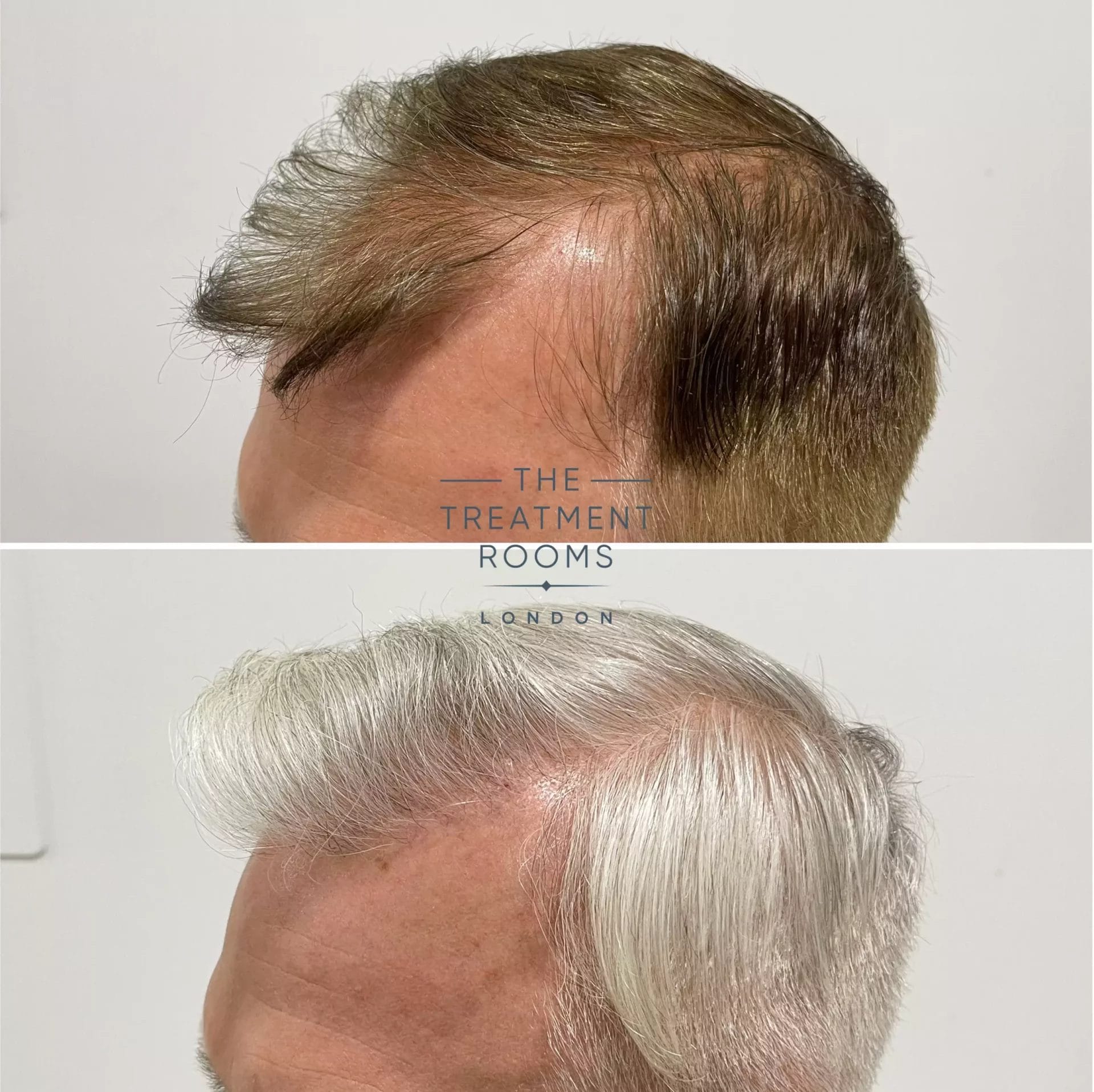 hair transplant london 1495 grafts before and after