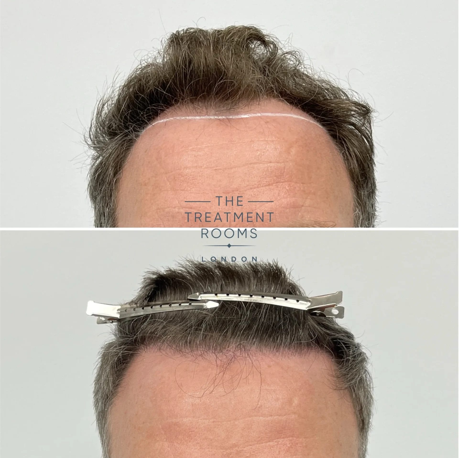 hair transplant london 1988 grafts before and after
