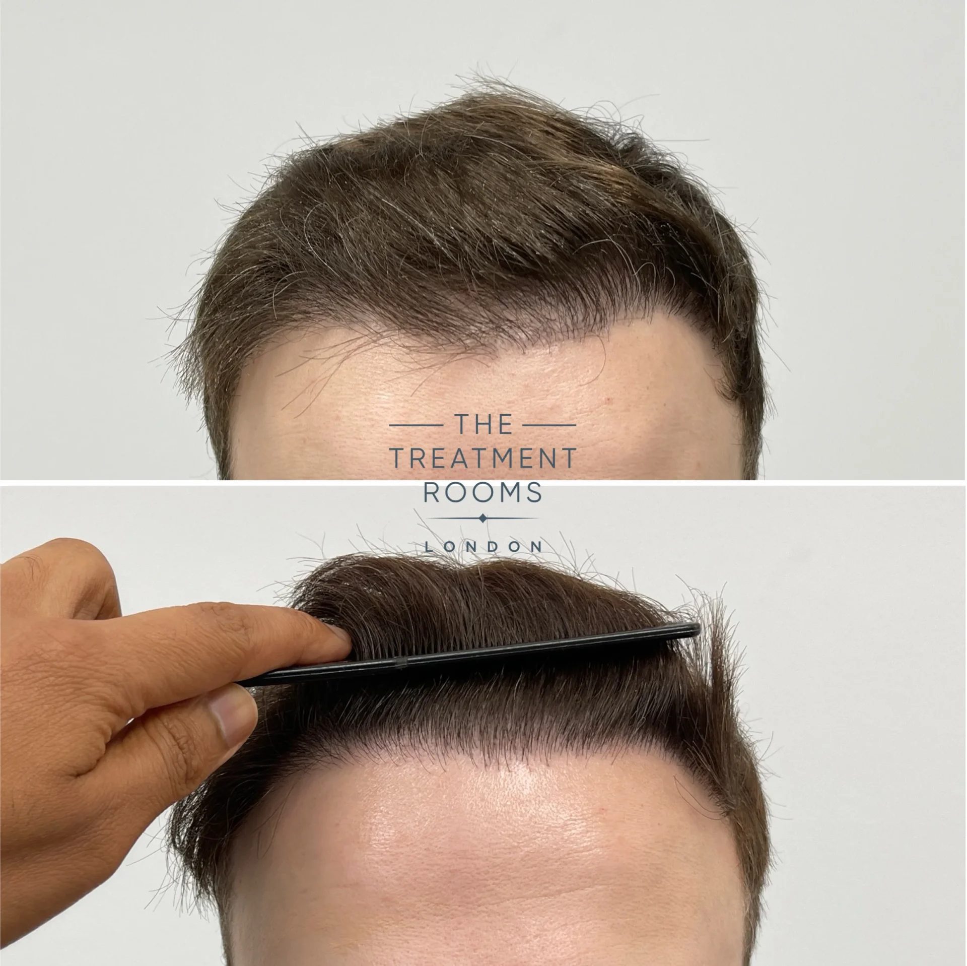 hair transplant repair 1239 grafts result