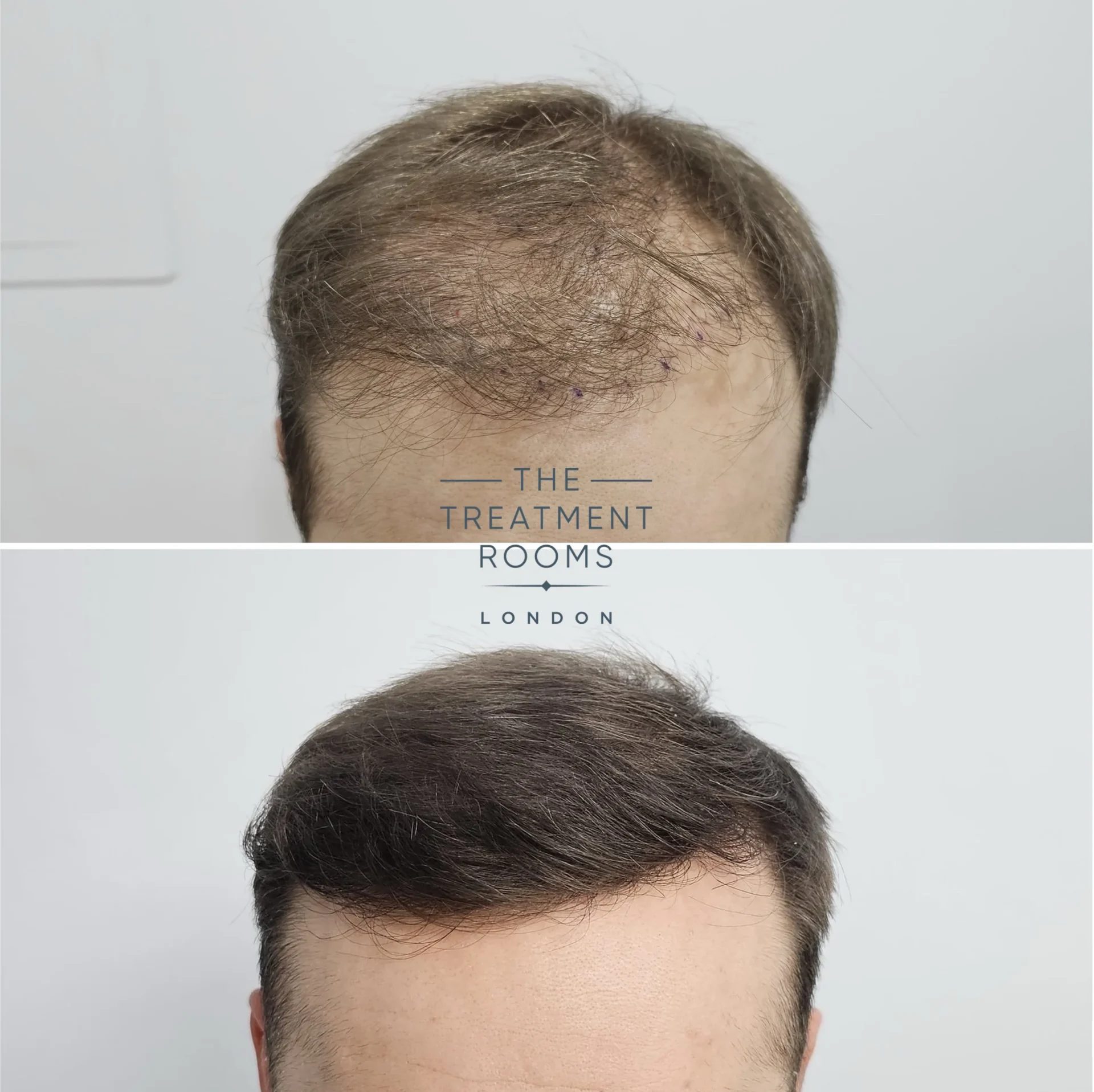 hair transplant repair 1733 grafts
