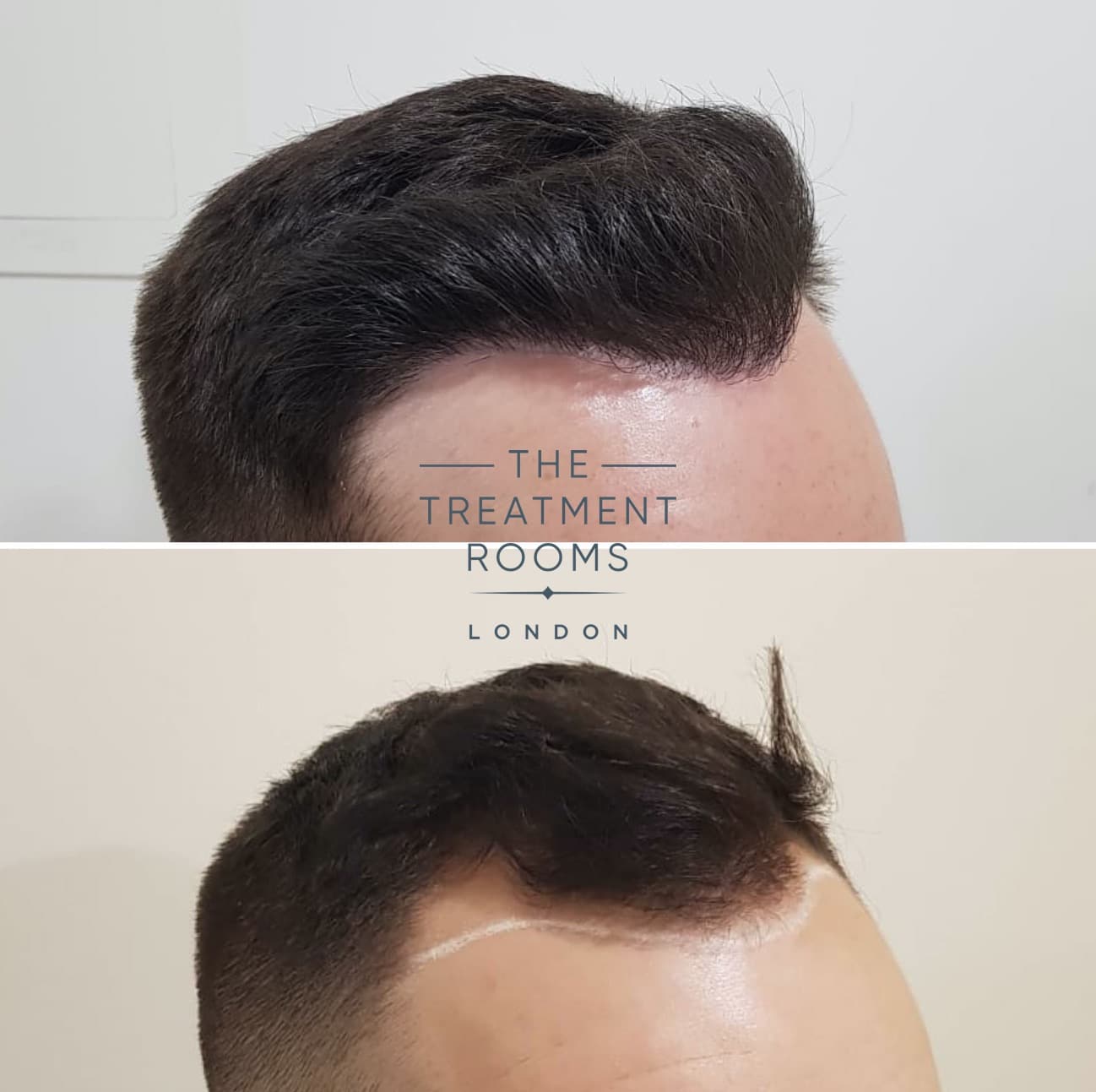 hairline FUE hair transplant before and after hairline FUE hair transplant before and after