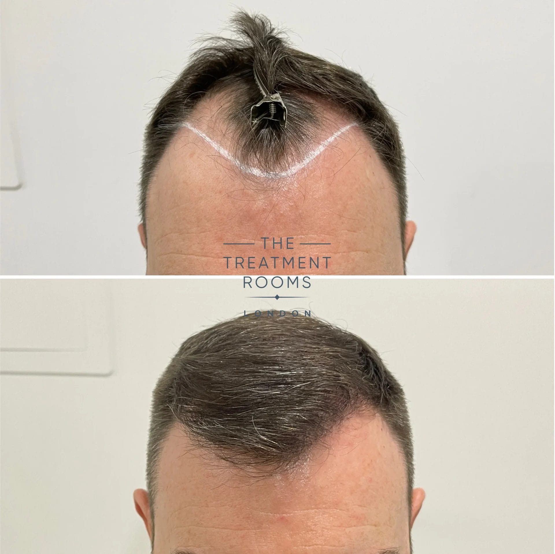 hairline and crown fue hair transplant london 2659 grafts before and after