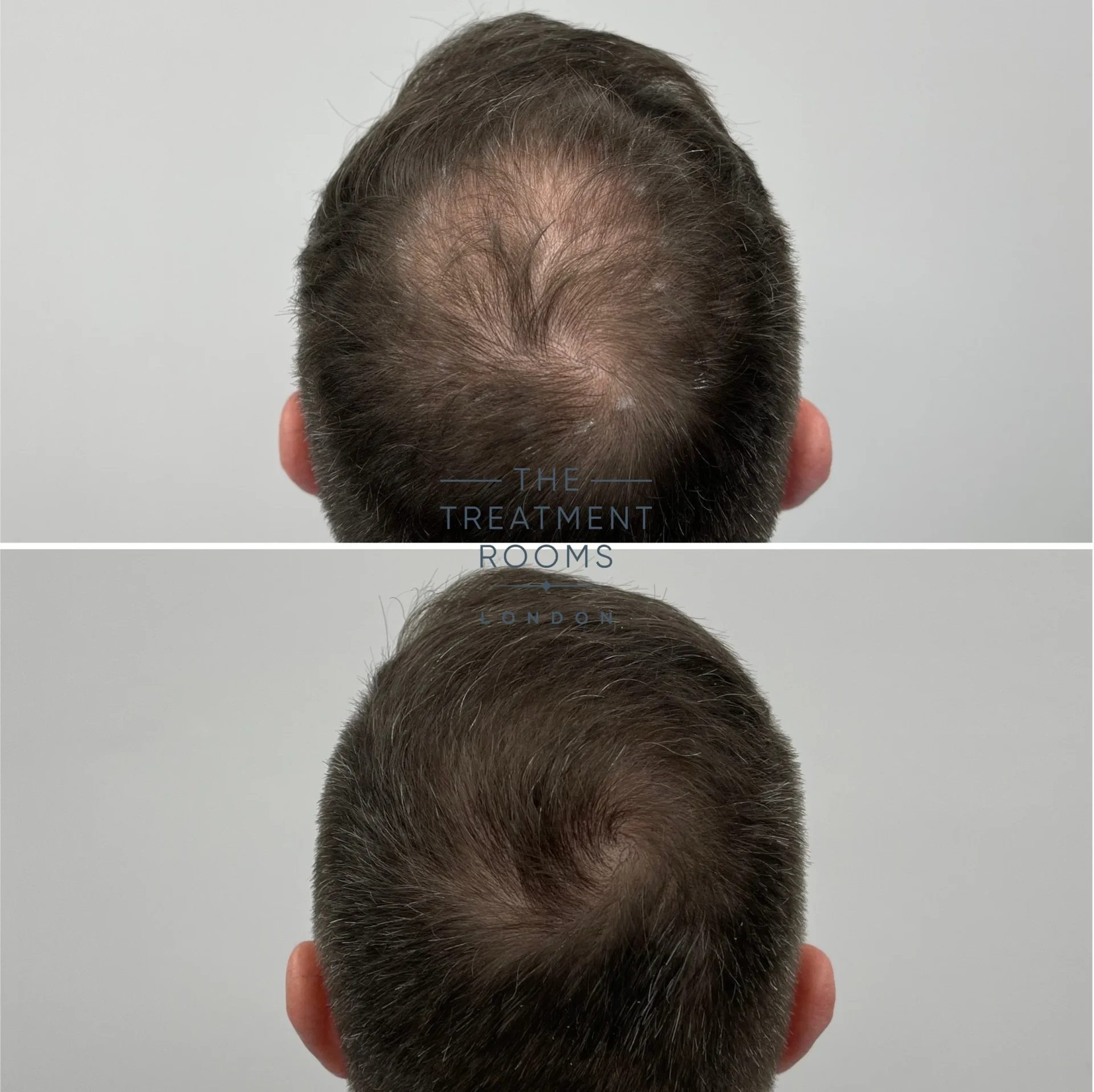 hairline and crown hair transplant london 2659 grafts before and after