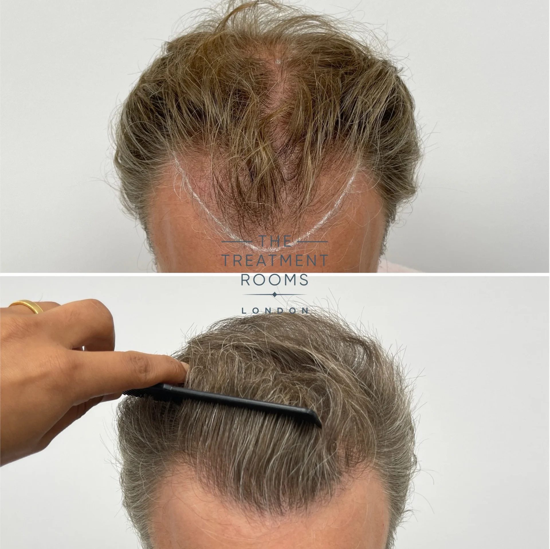 hairline and crown transplant 2278 grafts before and after