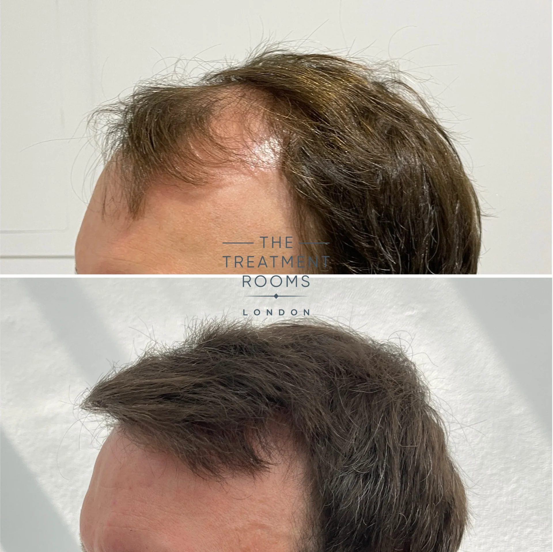 hairline fue hair transplant 3667 grafts before and after