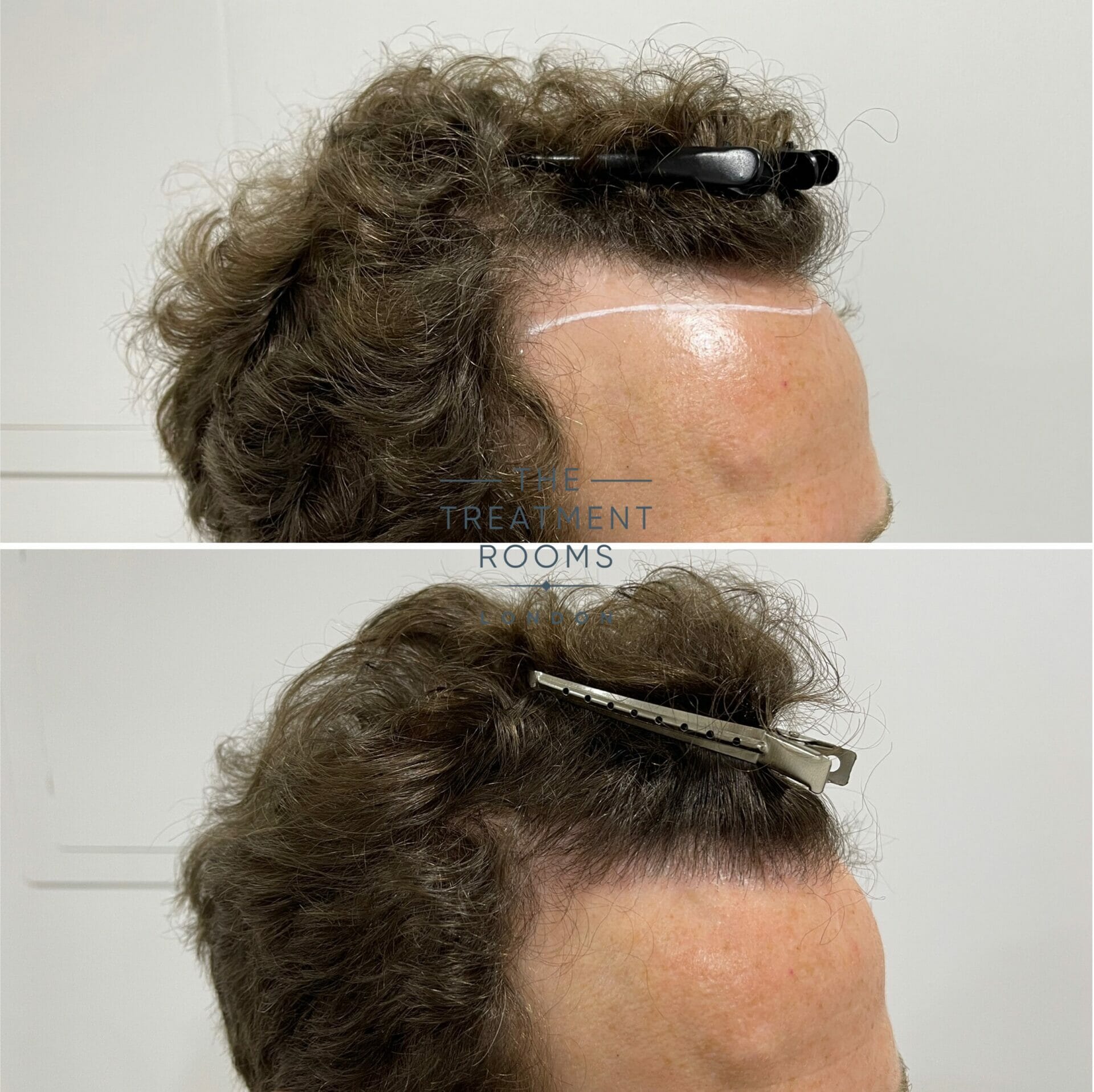 hairline fue hair transplant result 1304 grafts