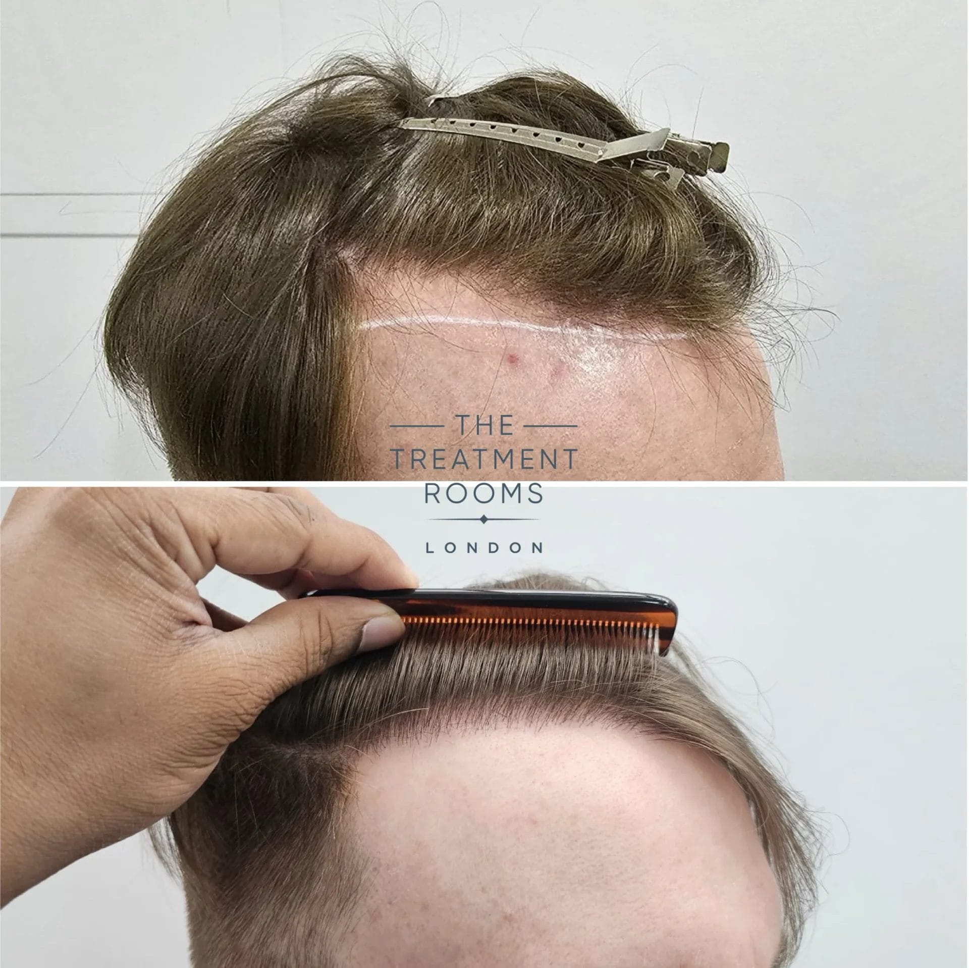 hairline fue transplant 1051 grafts before and after