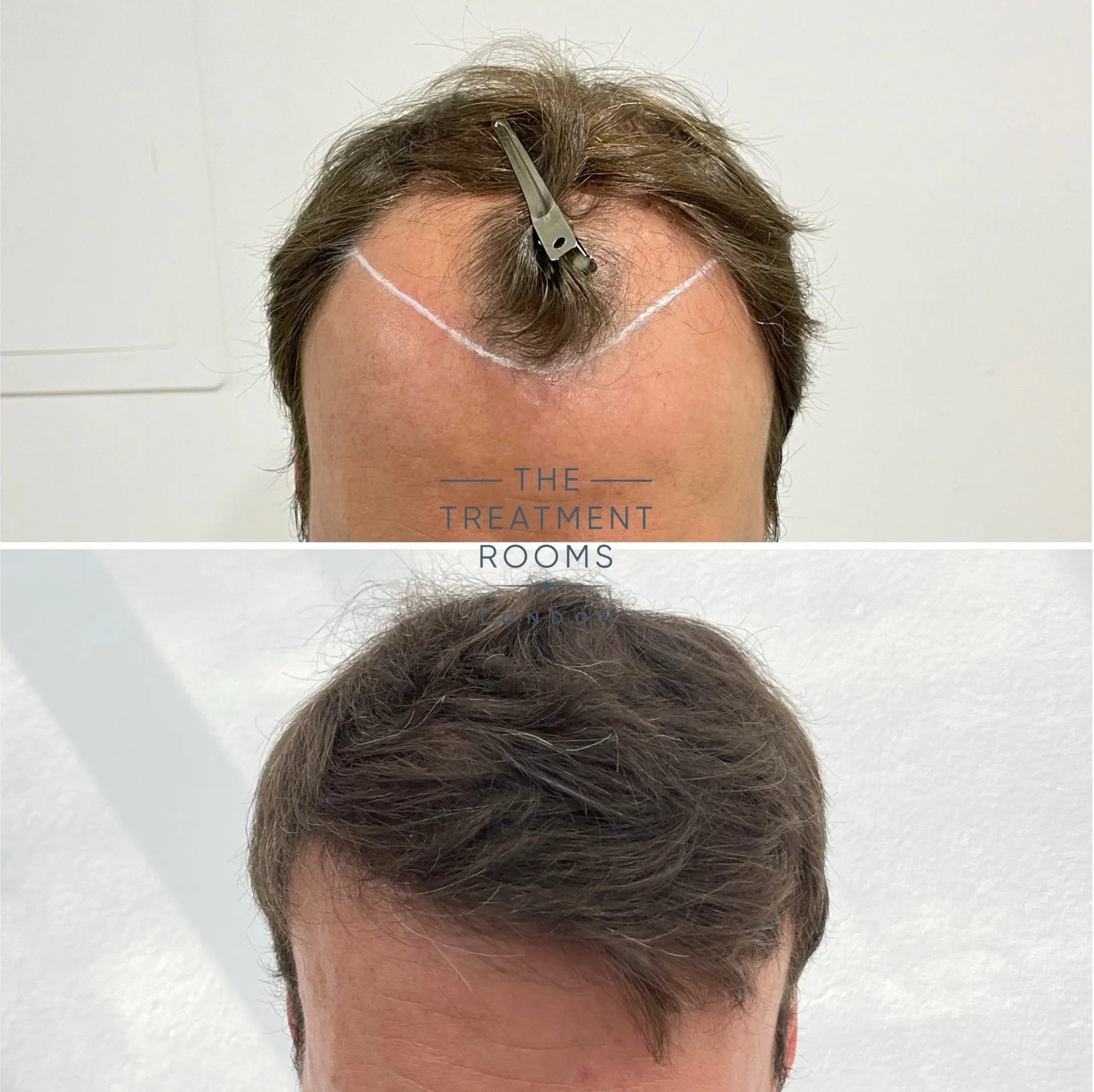 hairline fue transplant 3667 grafts before and after