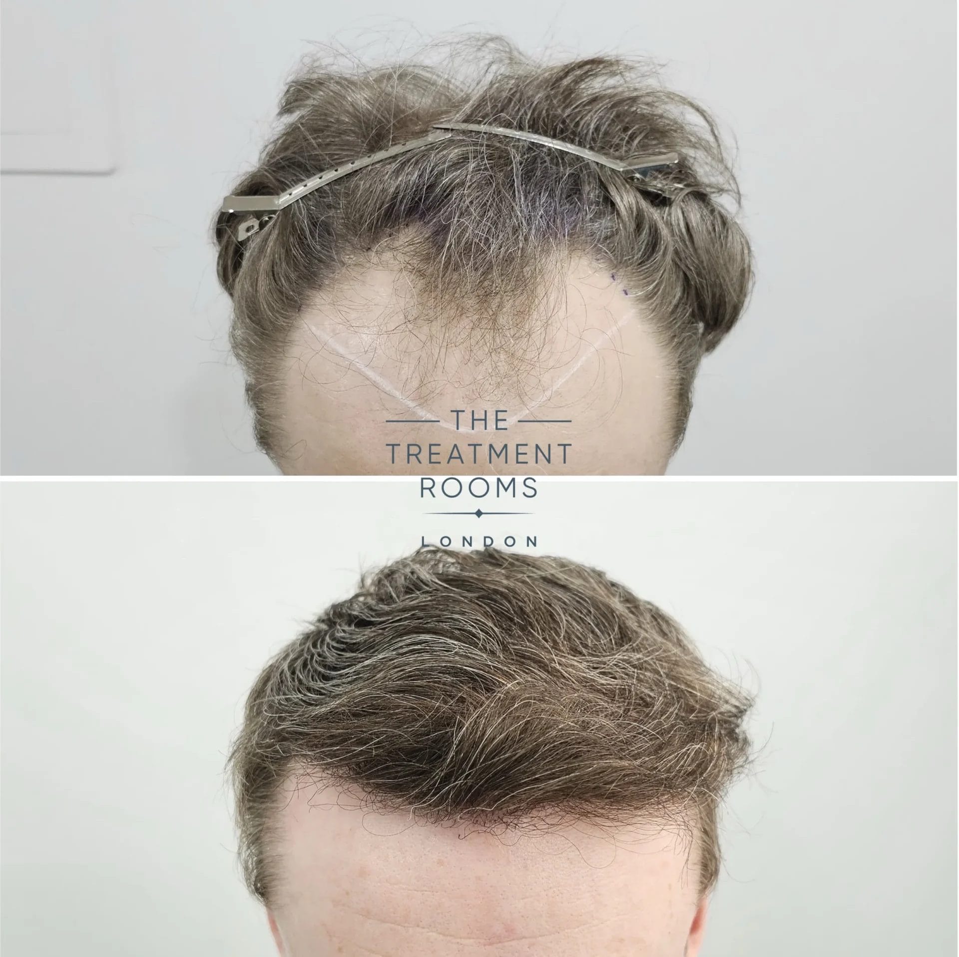 hairline fue transplant before and after 2069 grafts