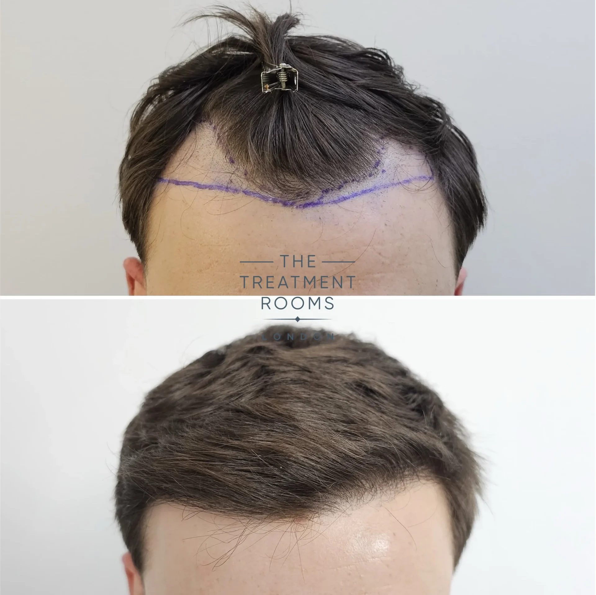 hairline fue transplant before and after 869 grafts hairline fue transplant before and after 869 grafts