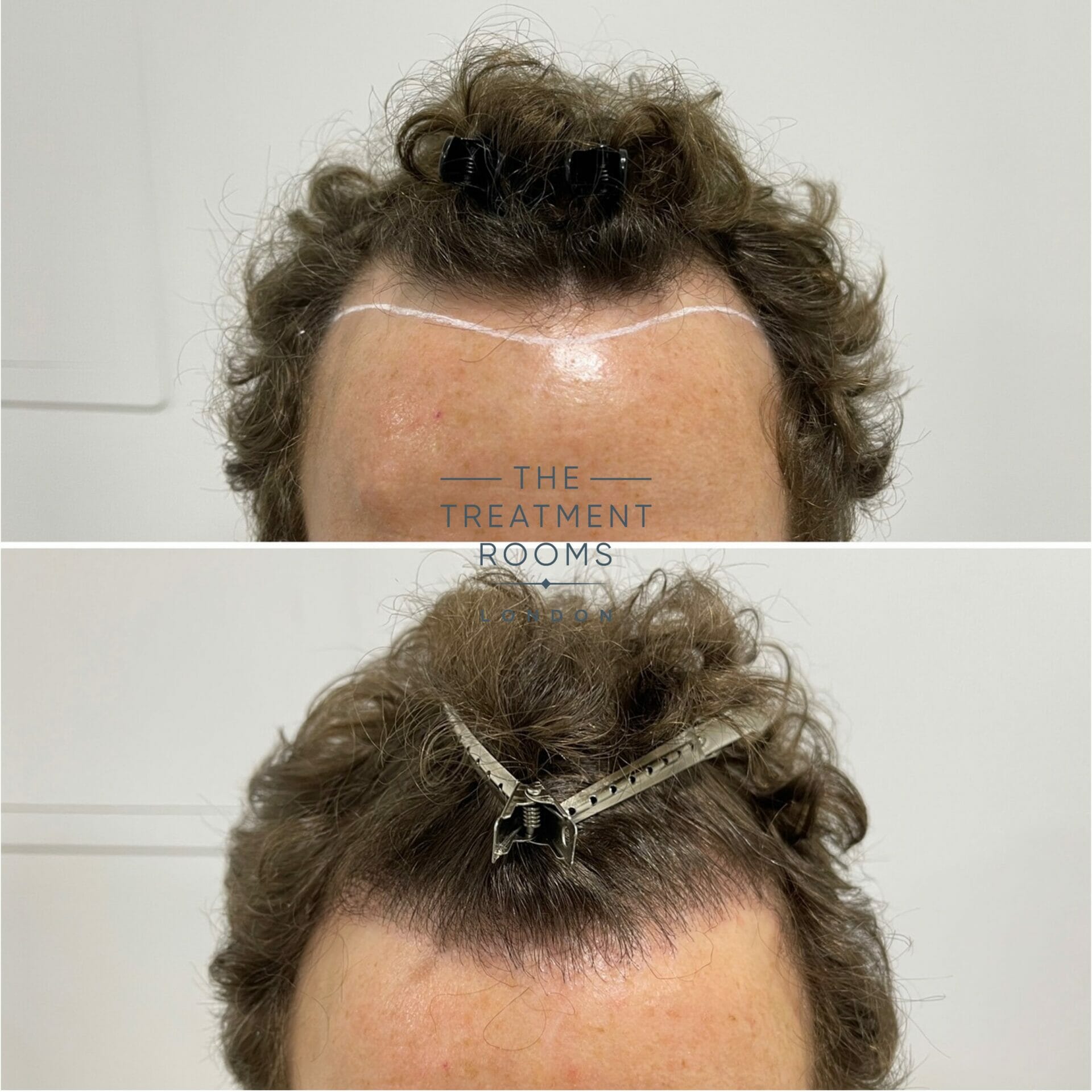 hairline hair transplant 1304 grafts