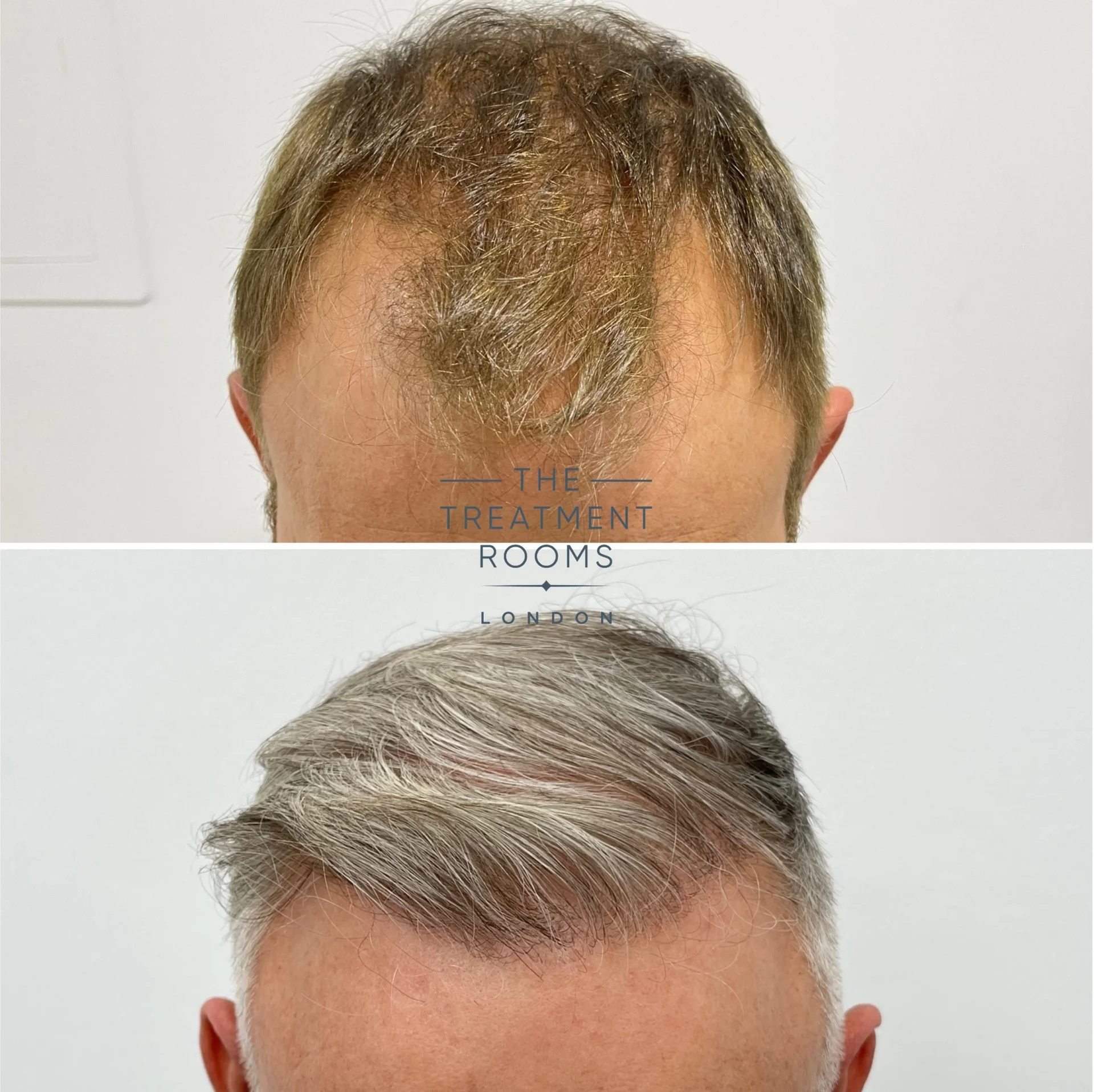 hairline hair transplant 1602 grafts before and after hairline hair transplant 1602 grafts before and after
