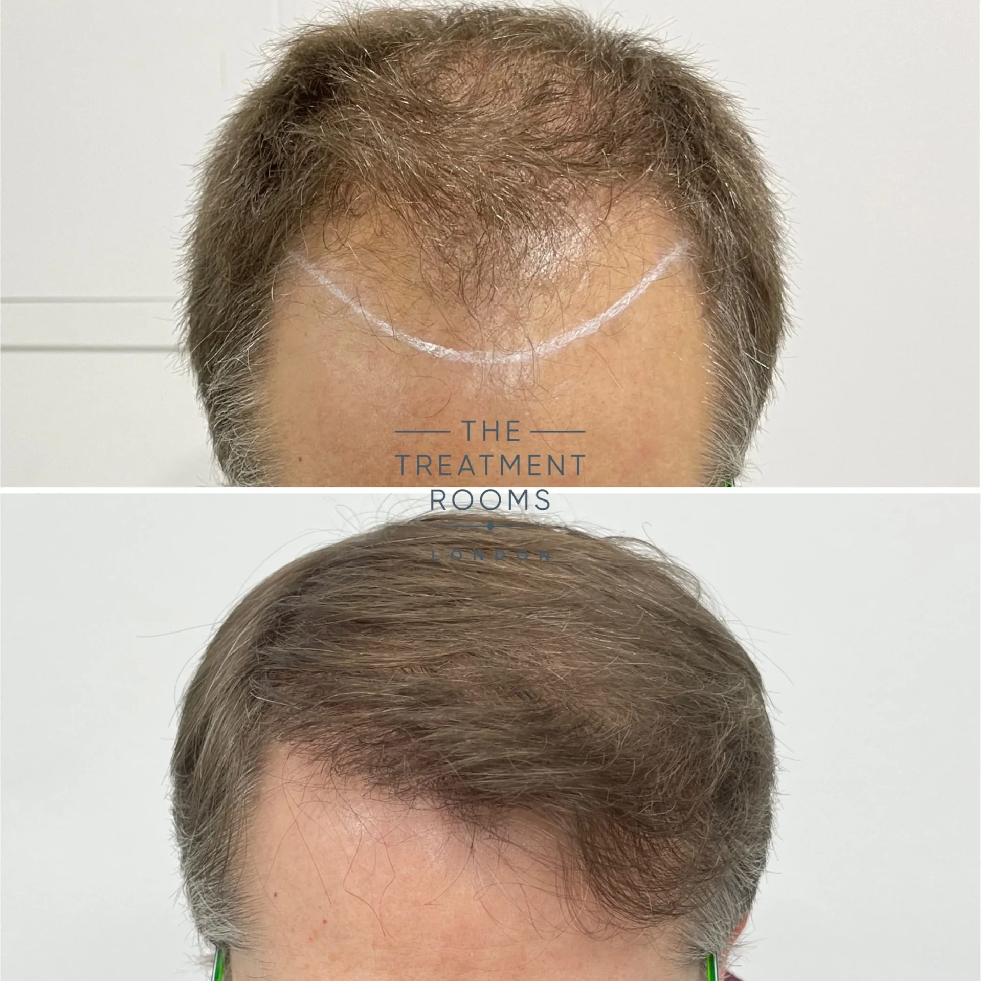 hairline hair transplant 1839 grafts before and after hairline hair transplant 1839 grafts before and after