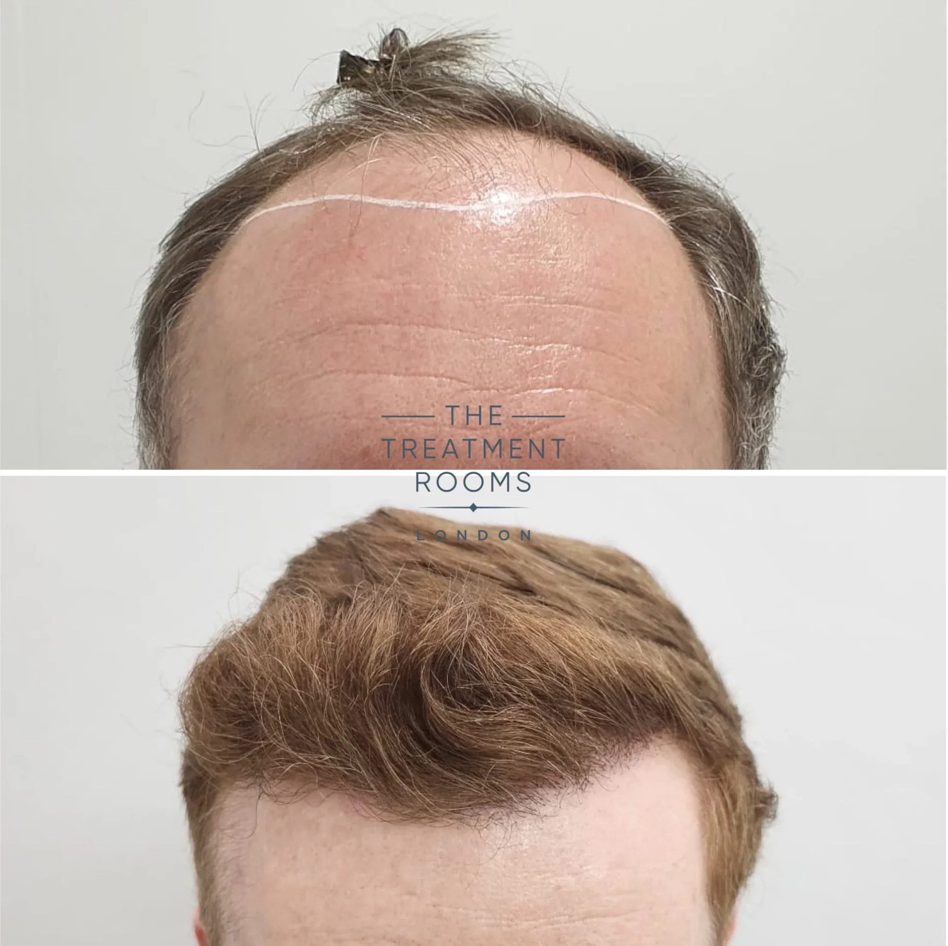 hairline hair transplant 2189 grafts before and after