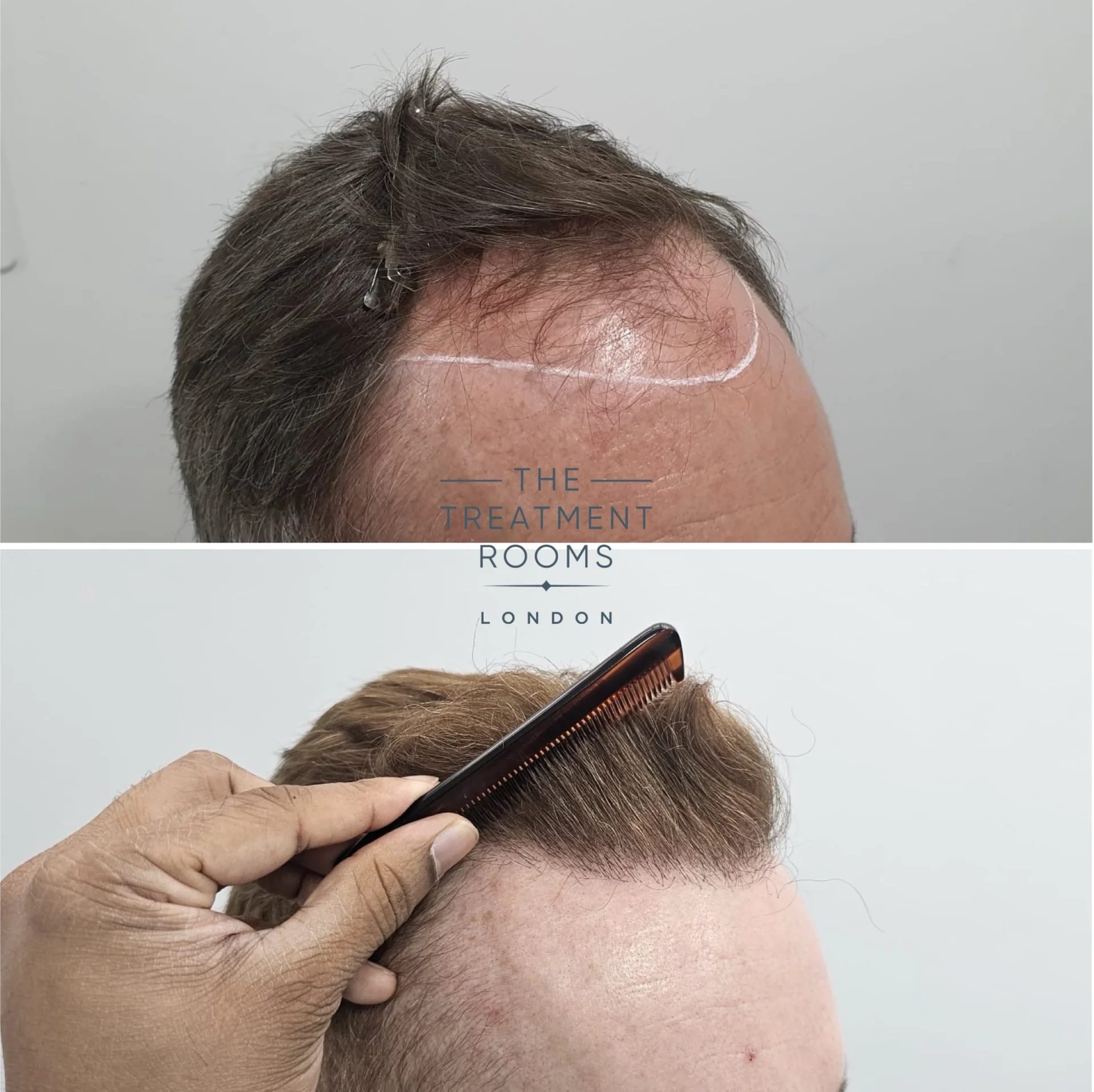 hairline hair transplant 2189 grafts result