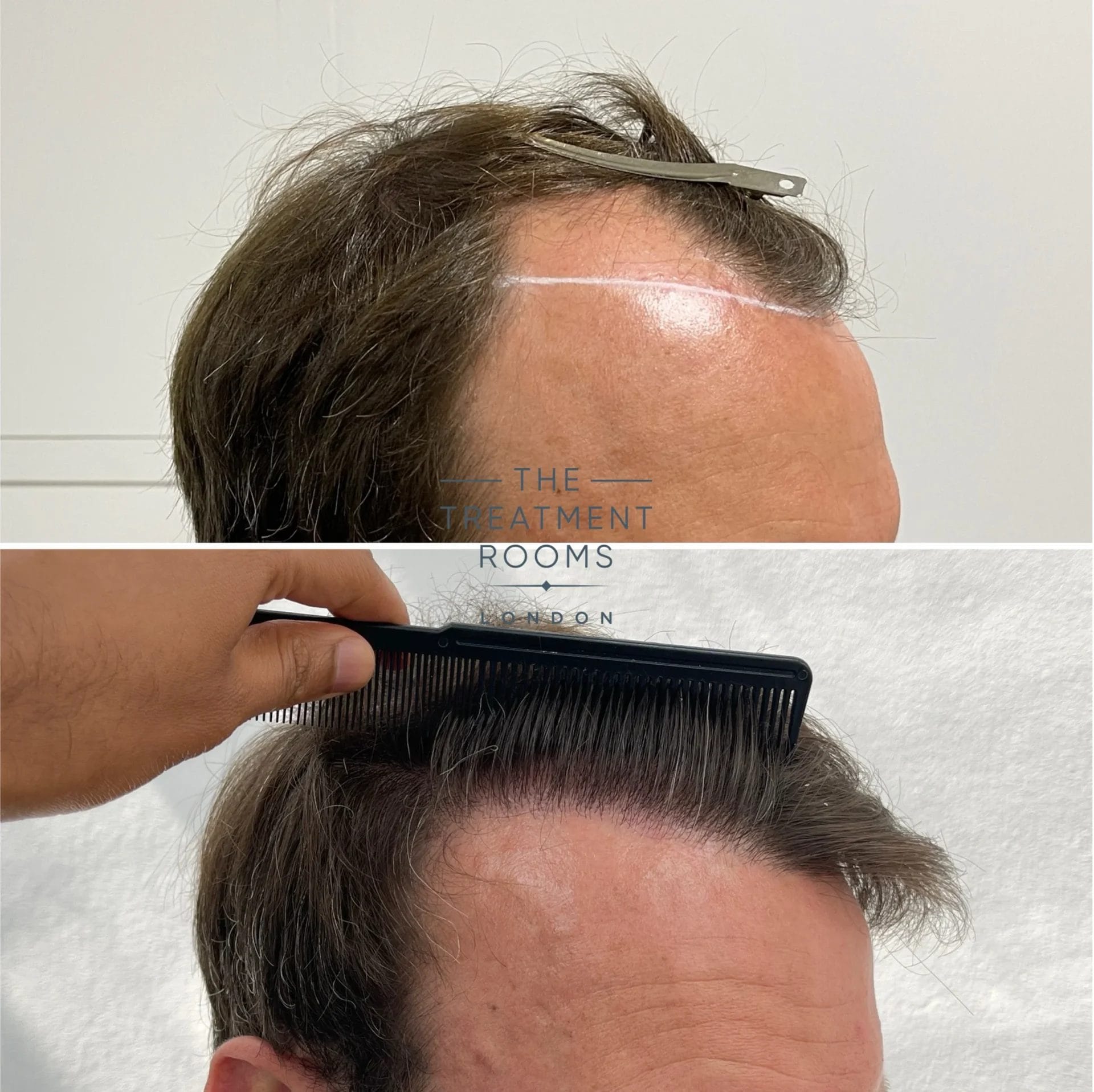 hairline hair transplant 3667 grafts before and after