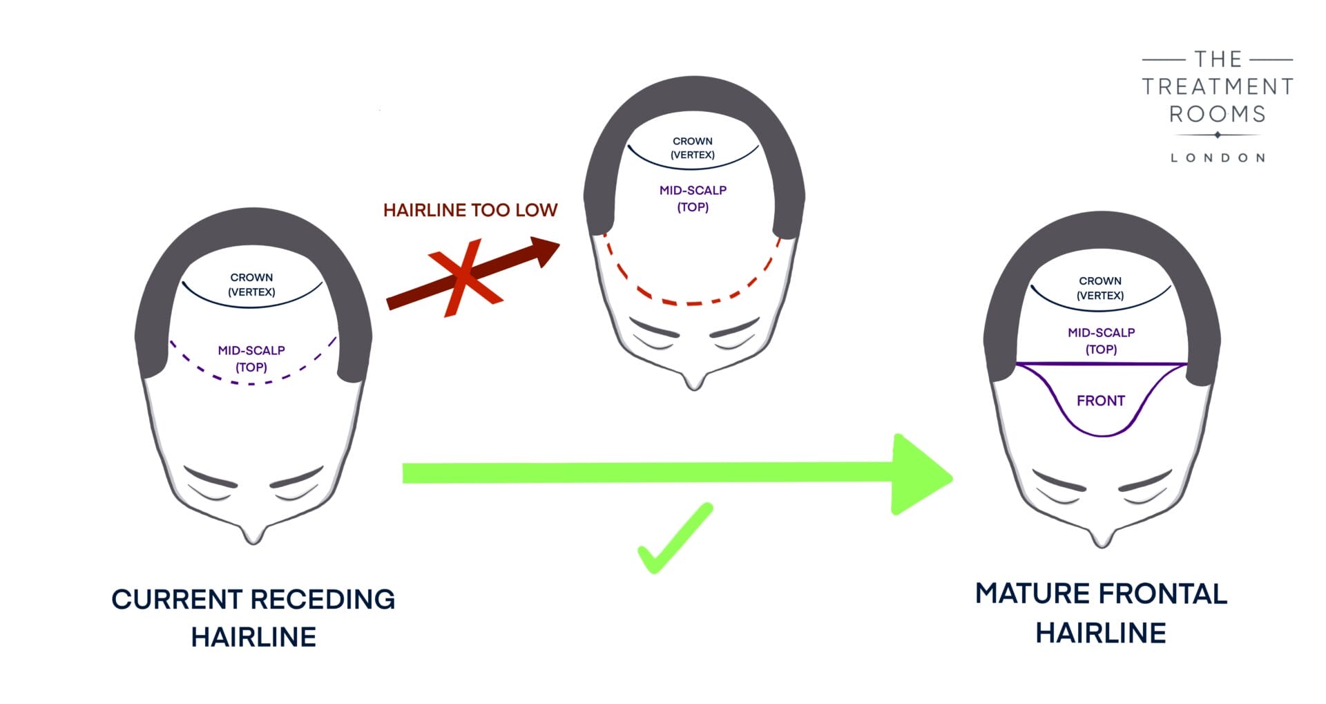 hairline hair transplant design diagram