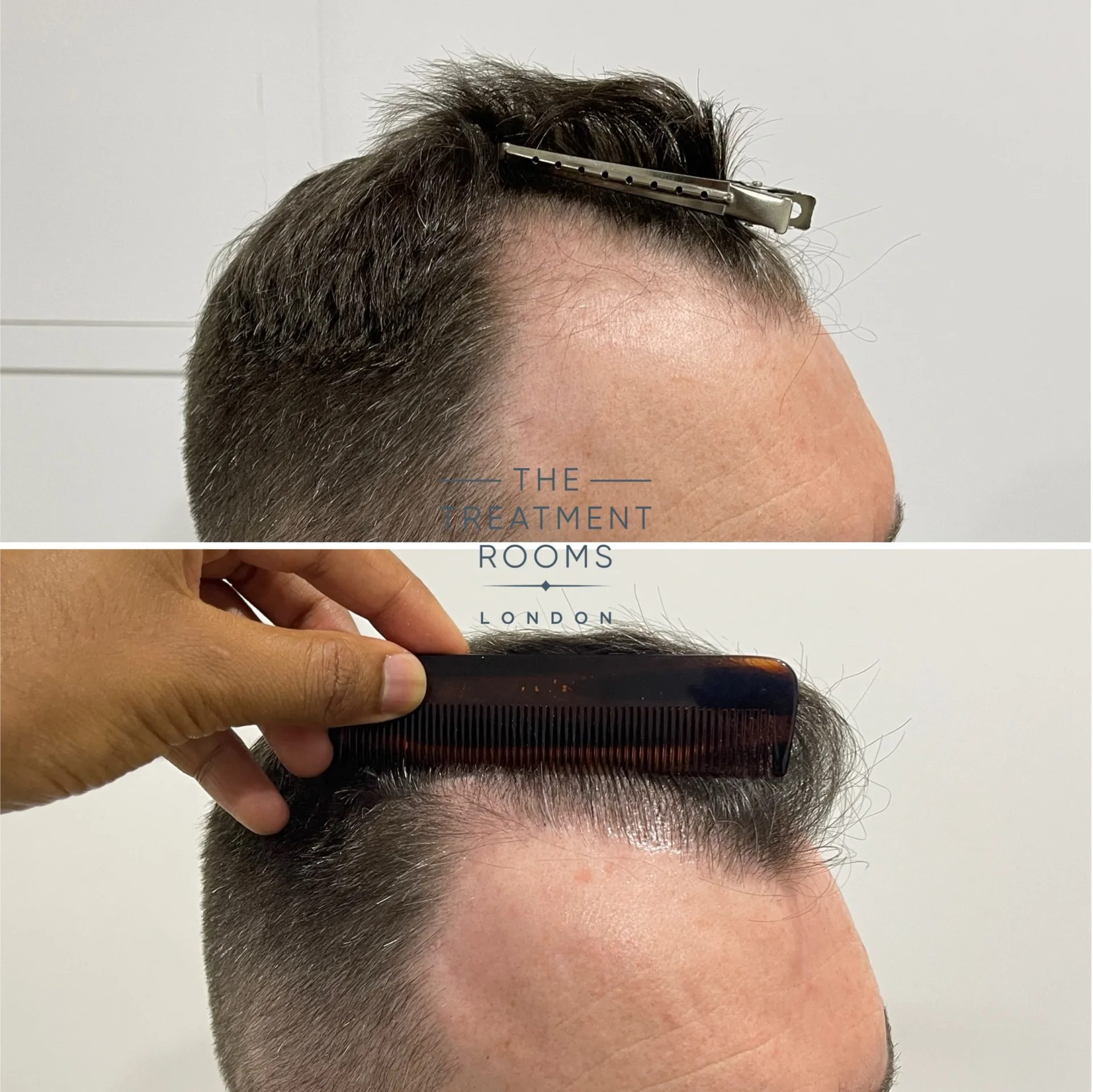 hairline hair transplant london 2659 grafts before and after