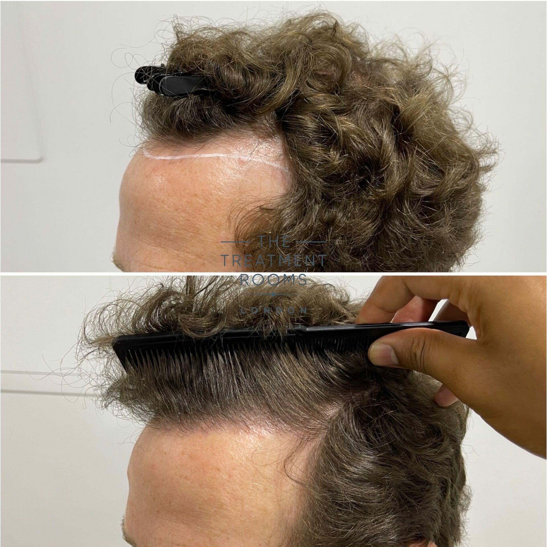 hairline hair transplant result 1304 grafts hairline hair transplant result 1304 grafts
