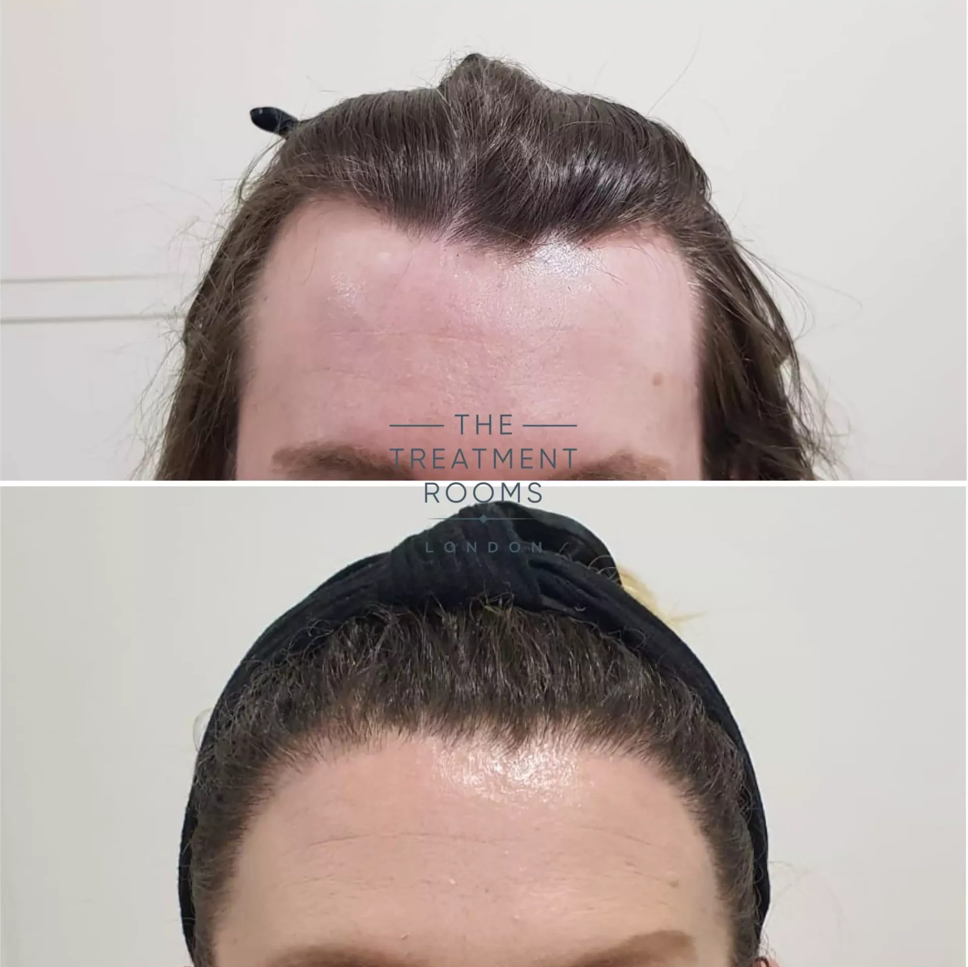 hairline transgender hair transplant clinic london 2319 grafts