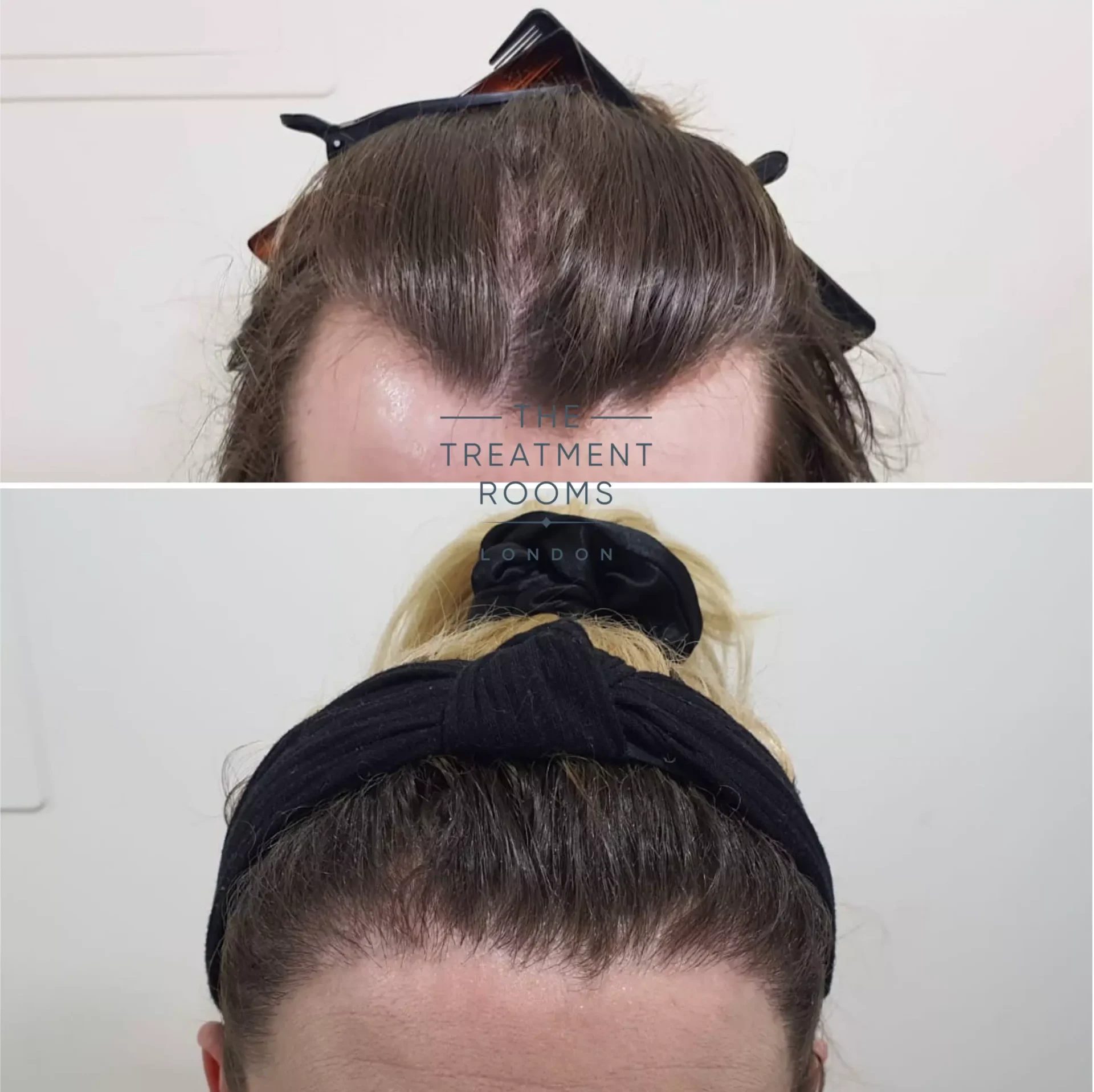 hairline transgender hair transplant london 2319 grafts