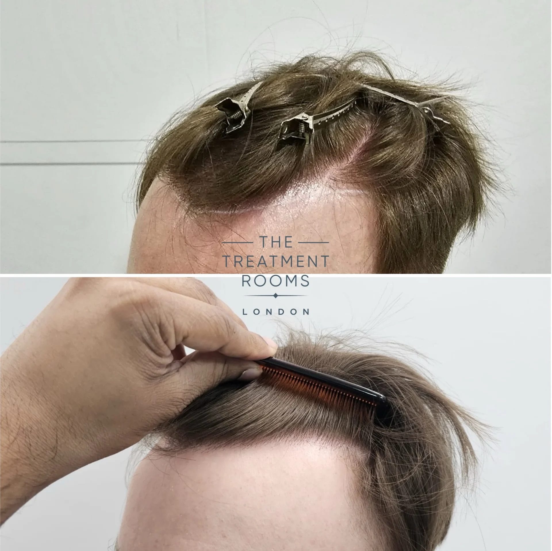 hairline transplant 1051 grafts before and after surgery
