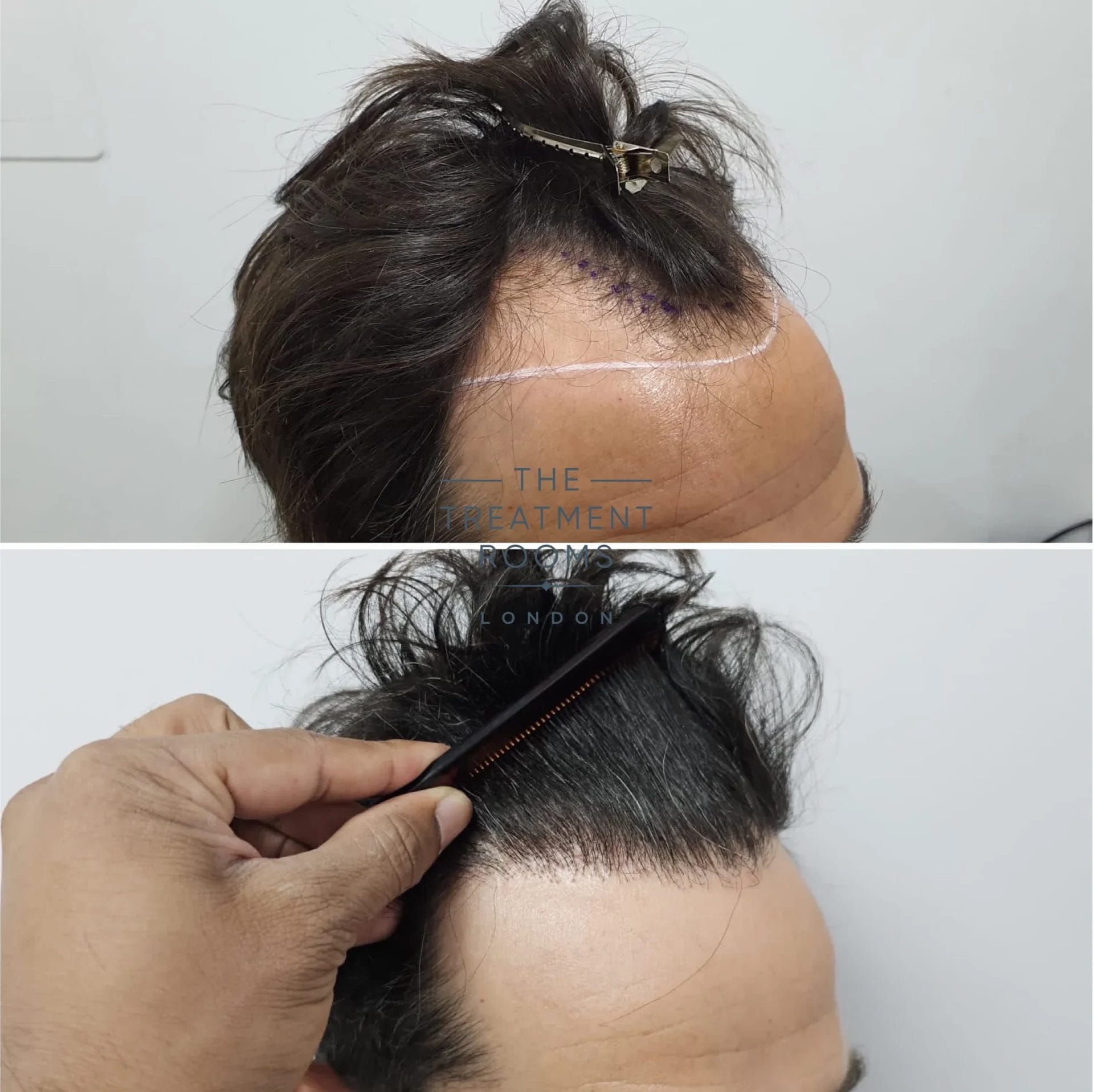hairline transplant 1739 grafts