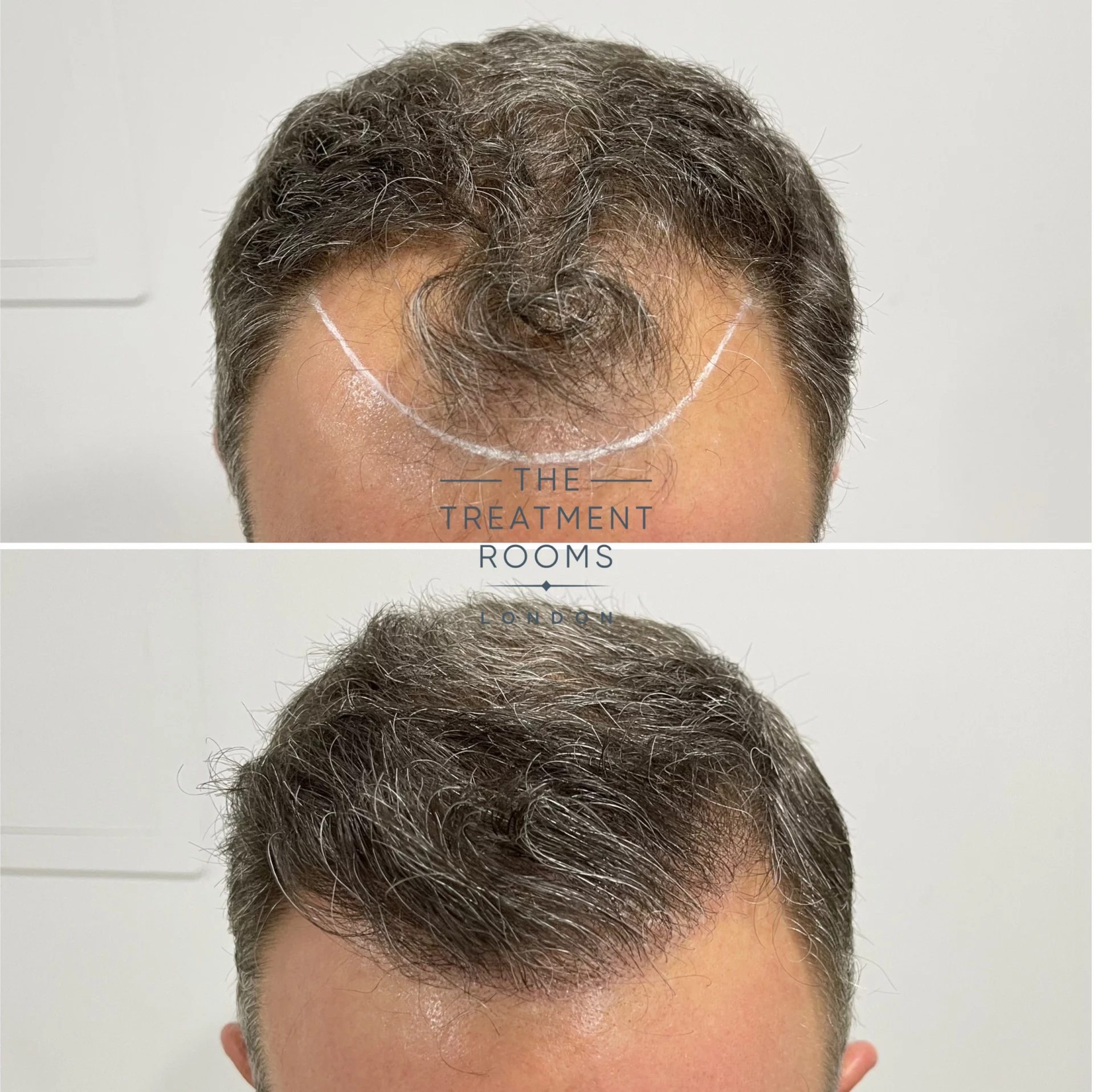 hairline transplant 1788 grafts before and after hairline transplant 1788 grafts before and after