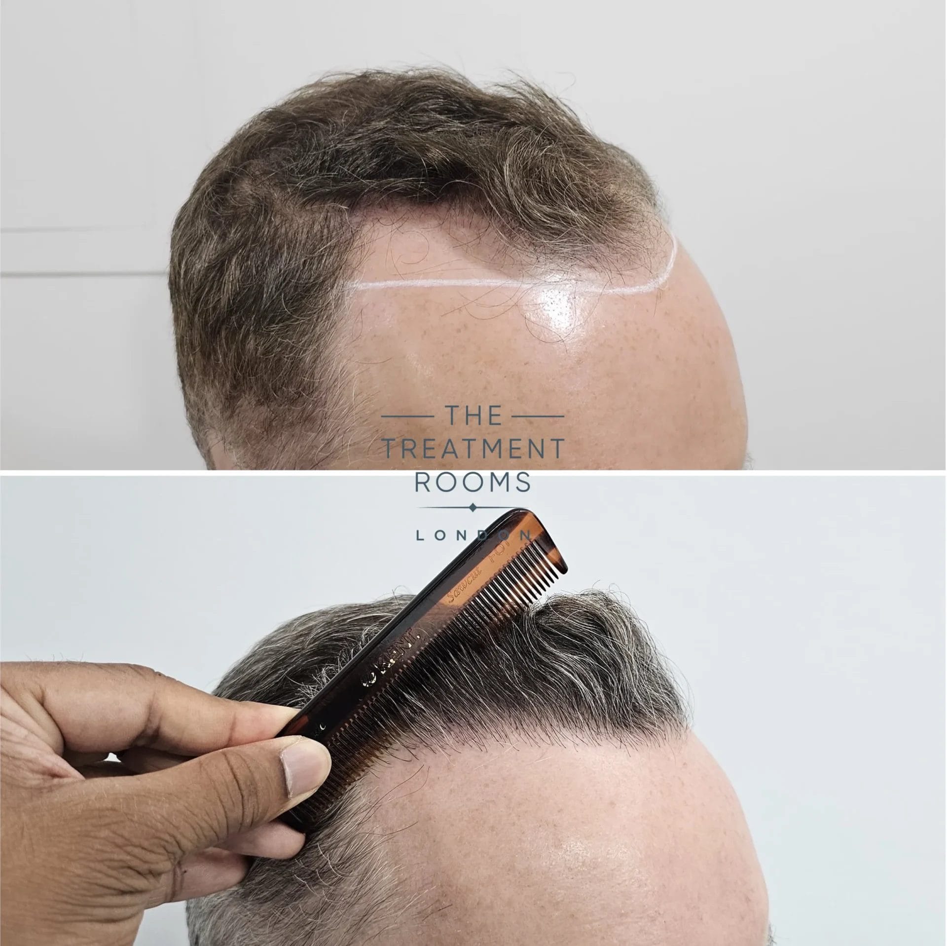 hairline transplant 1820 grafts before and after