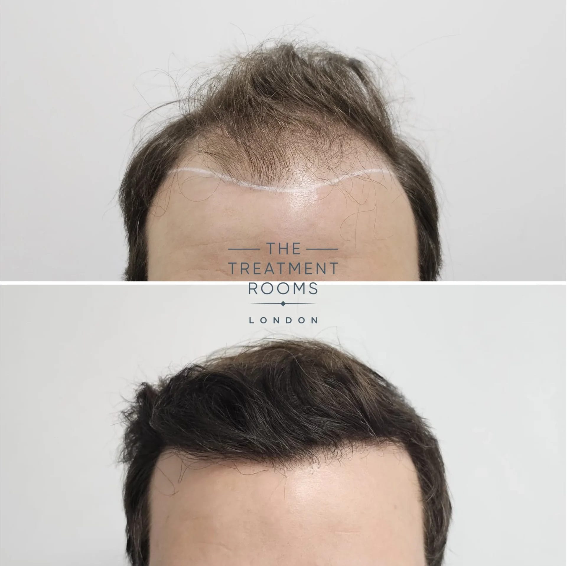 hairline transplant 2198 grafts before and after