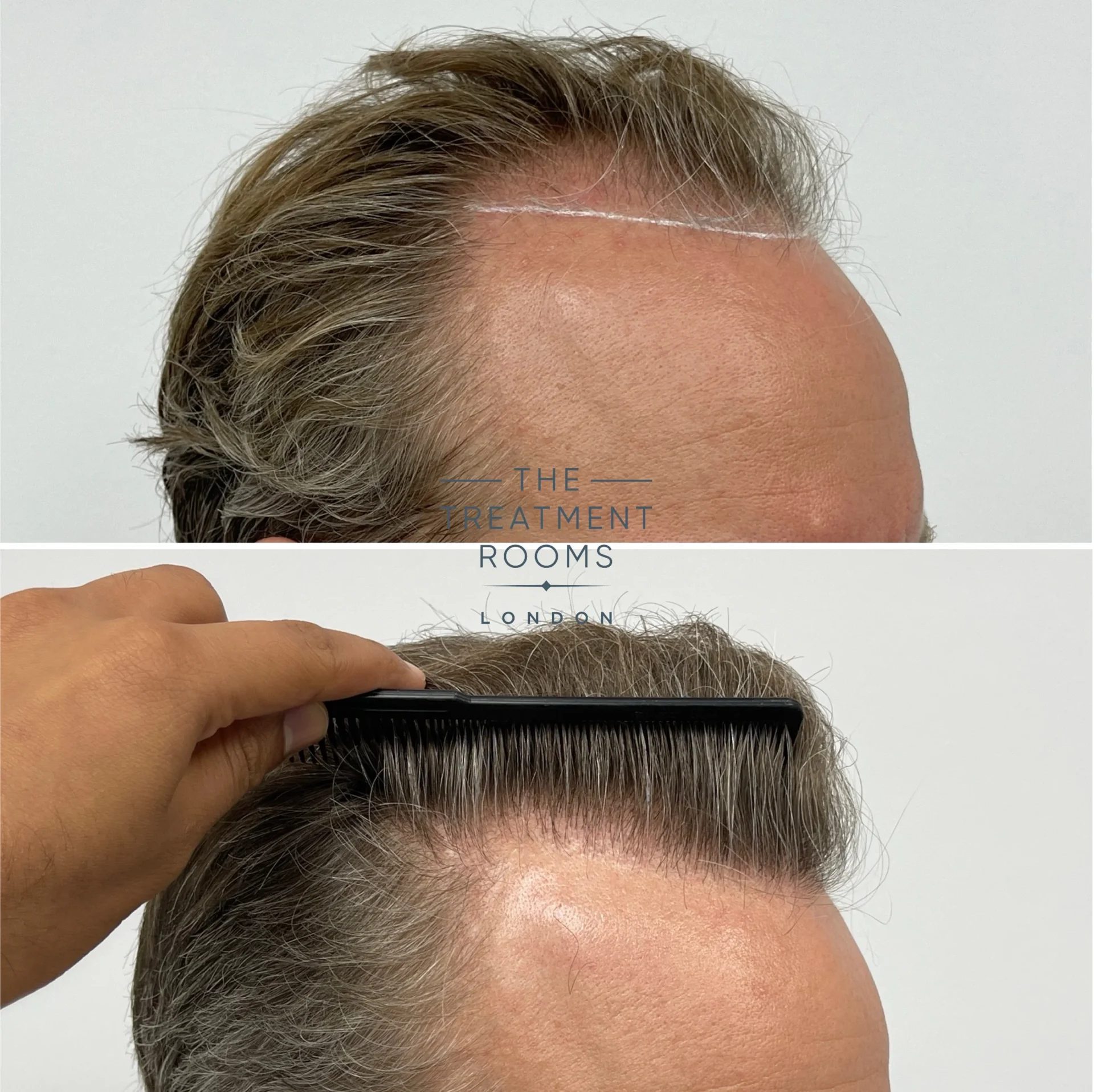 hairline transplant 2278 grafts before and after