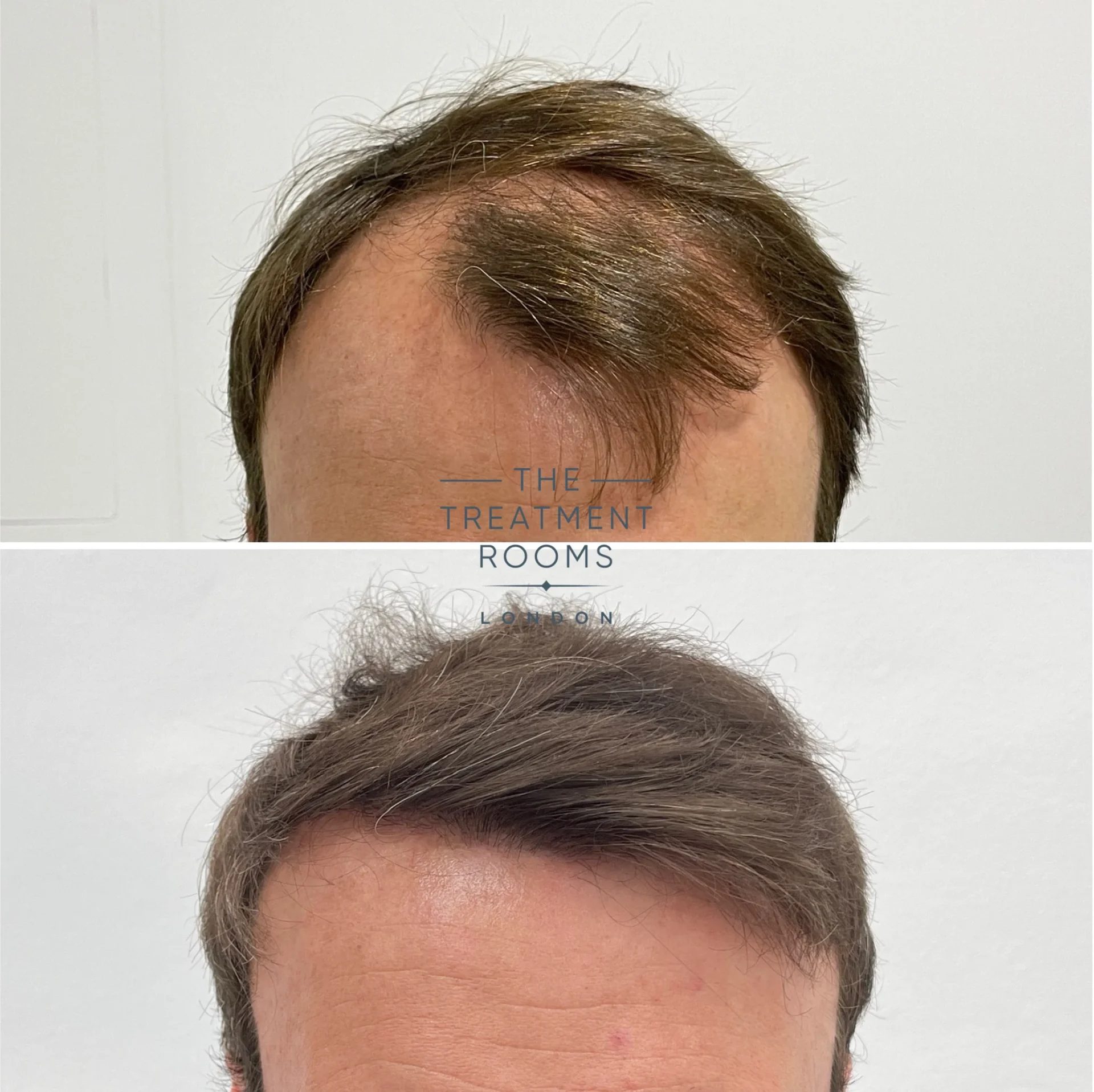 hairline transplant 3667 grafts before and after