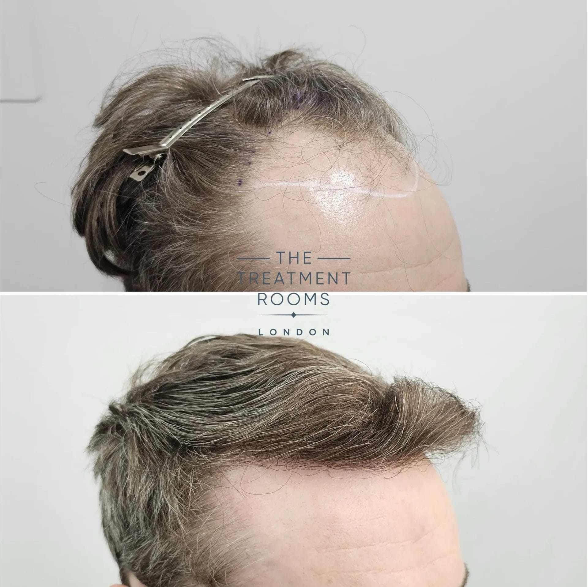 hairline transplant before and after 2069 grafts