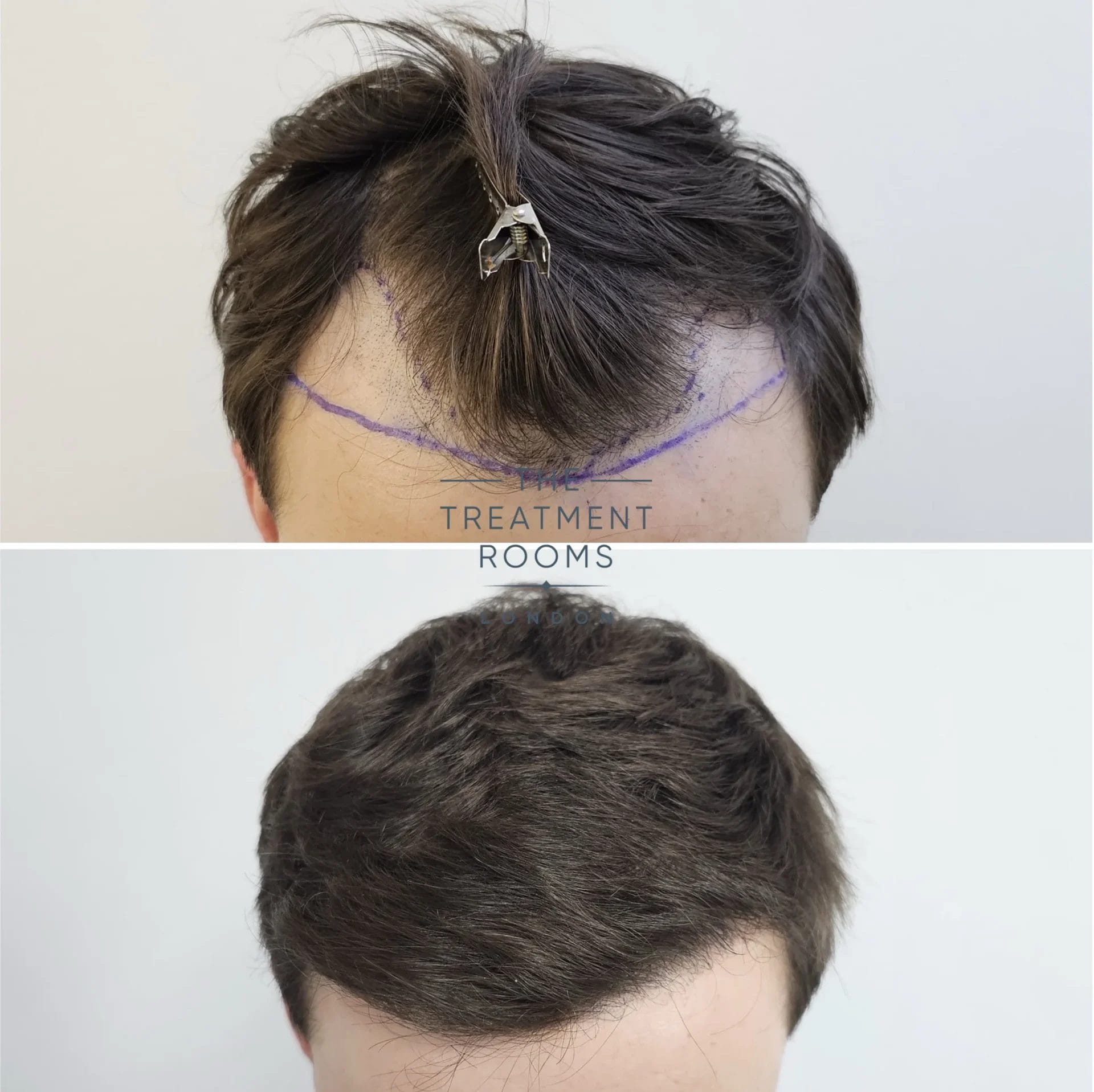 hairline transplant before and after 869 grafts