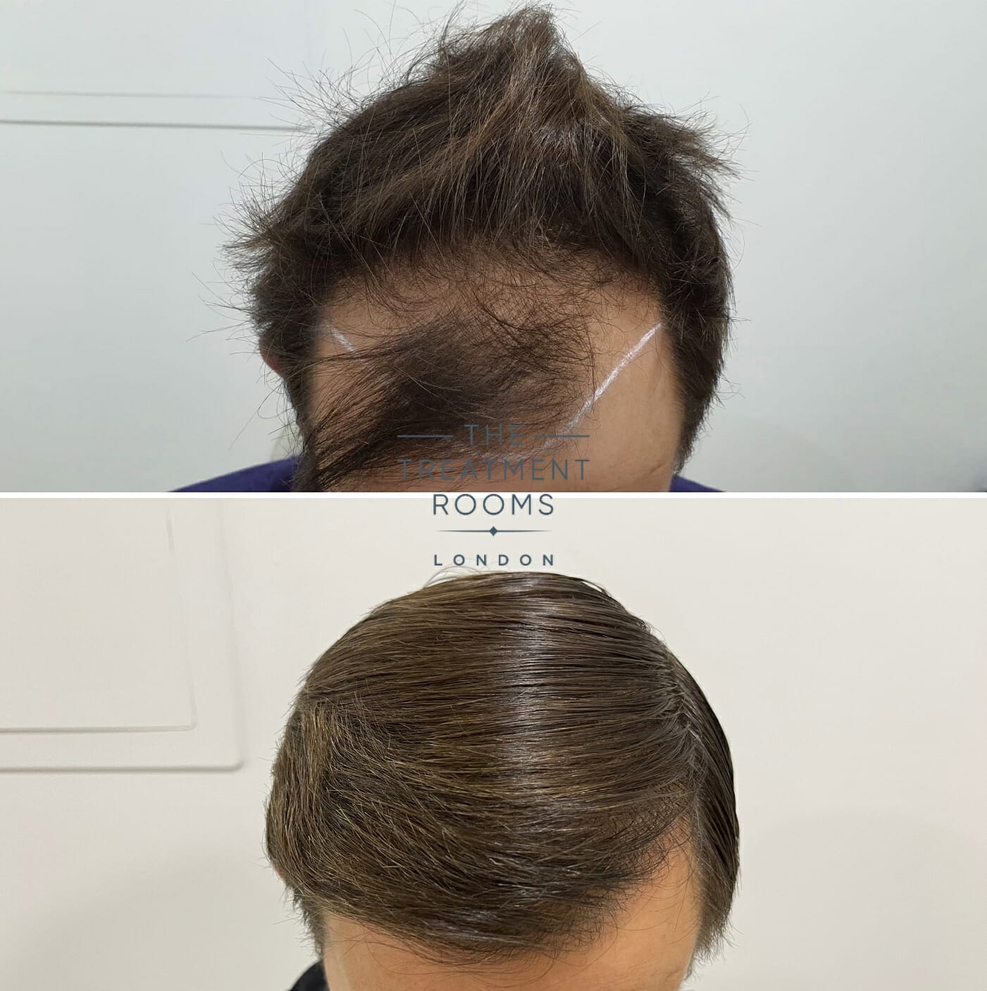 hairline transplant before and after hairline transplant before and after