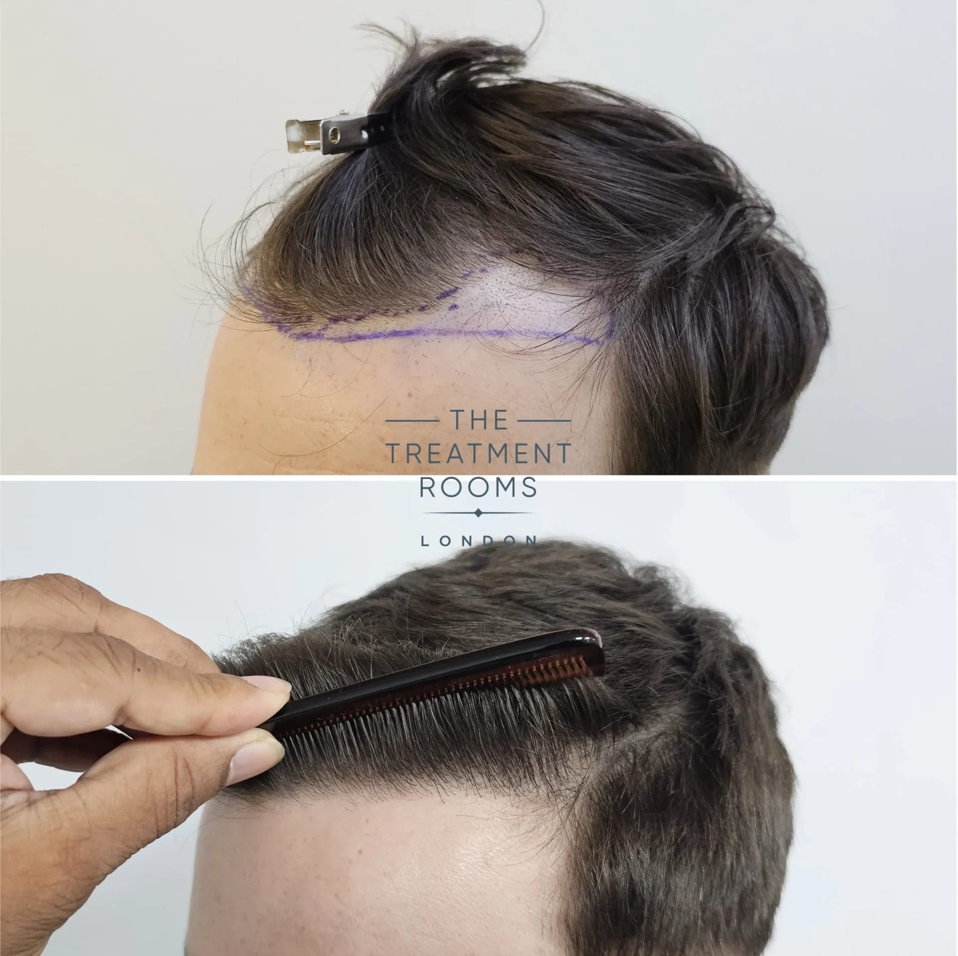 hairline transplant clinic before and after 869 grafts