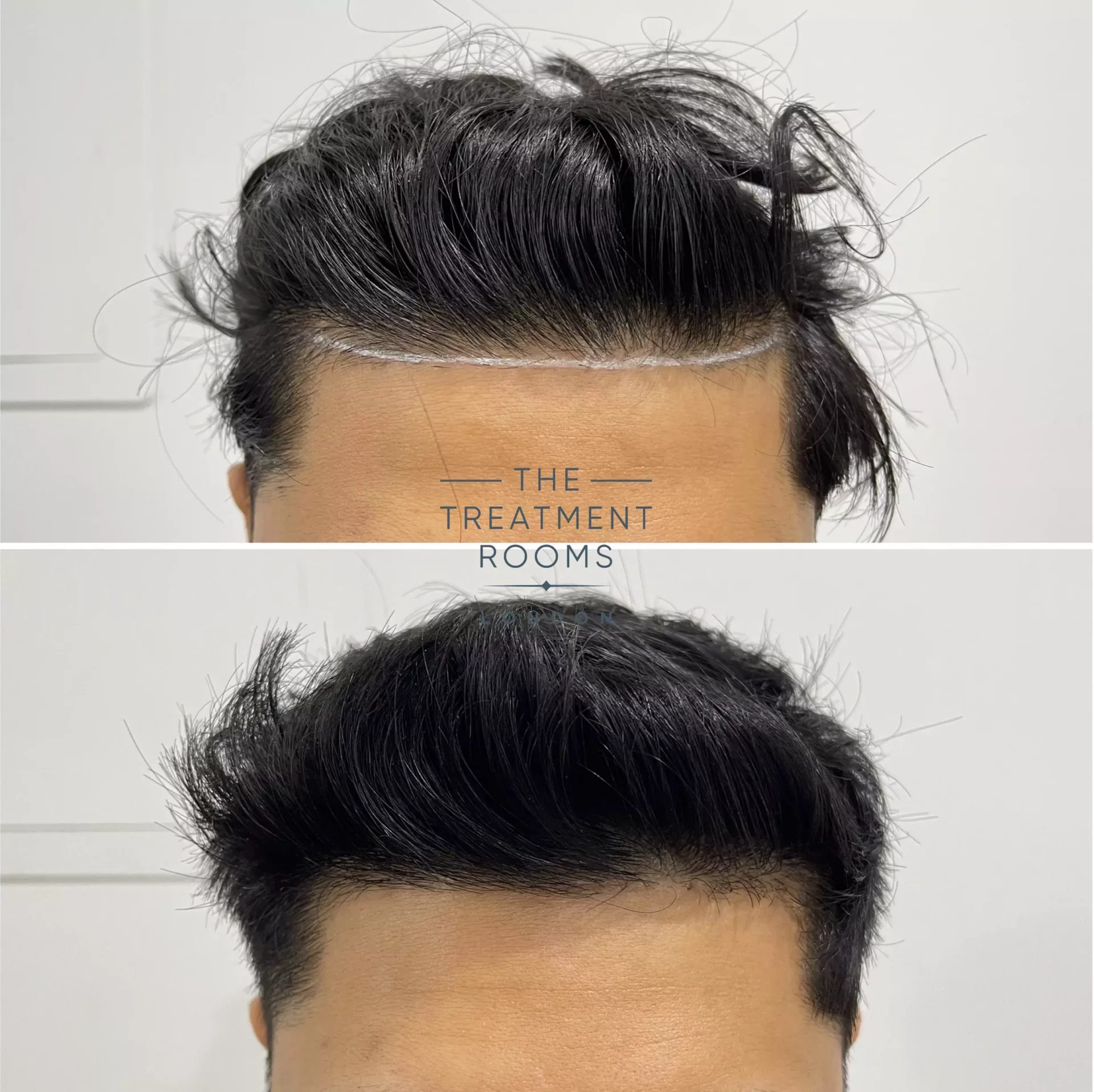 hairline transplant london 1019 grafts hairline transplant london 1019 grafts