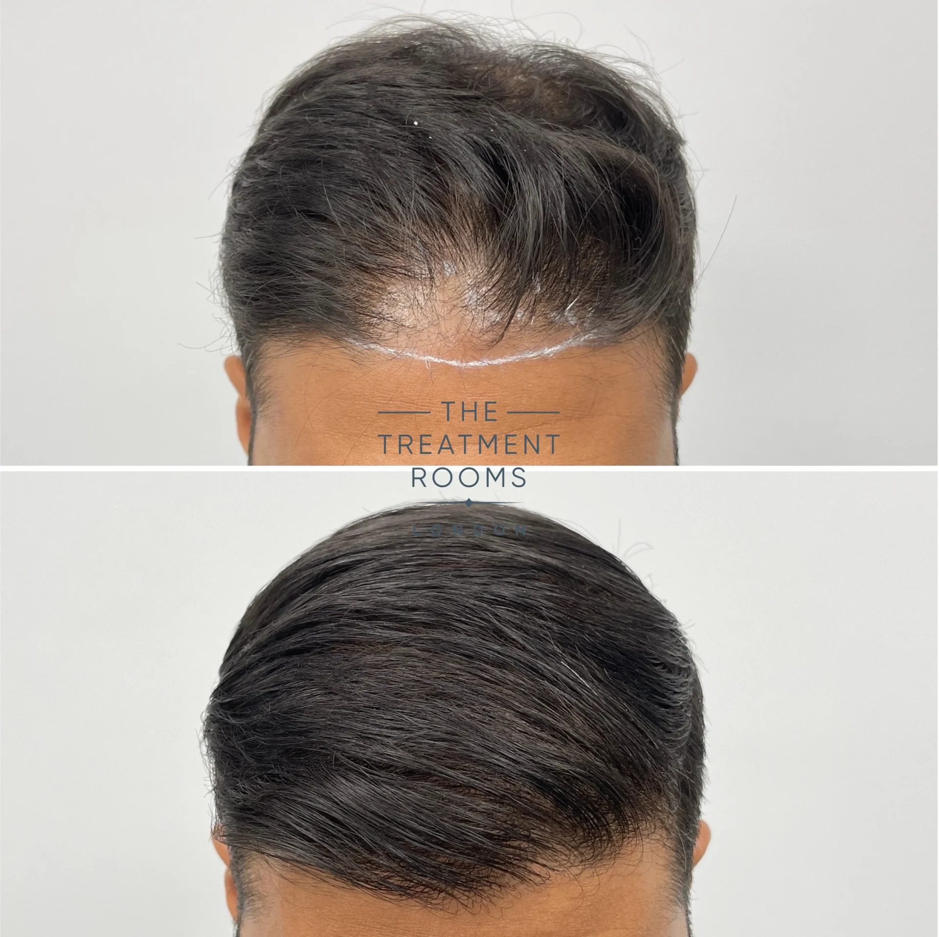 hairline transplant london 1411 grafts