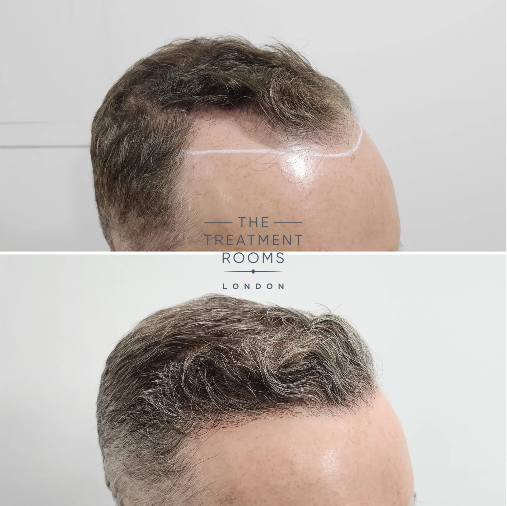 hairline transplant london 1820 grafts before and after