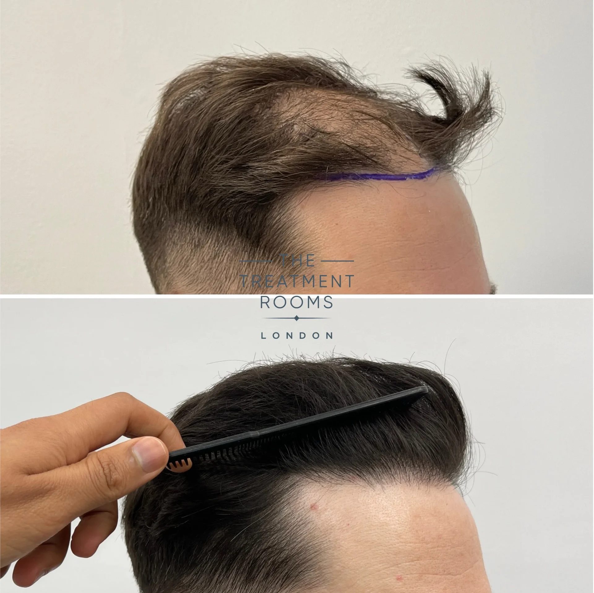 hairline transplant london before and after 1625 grafts