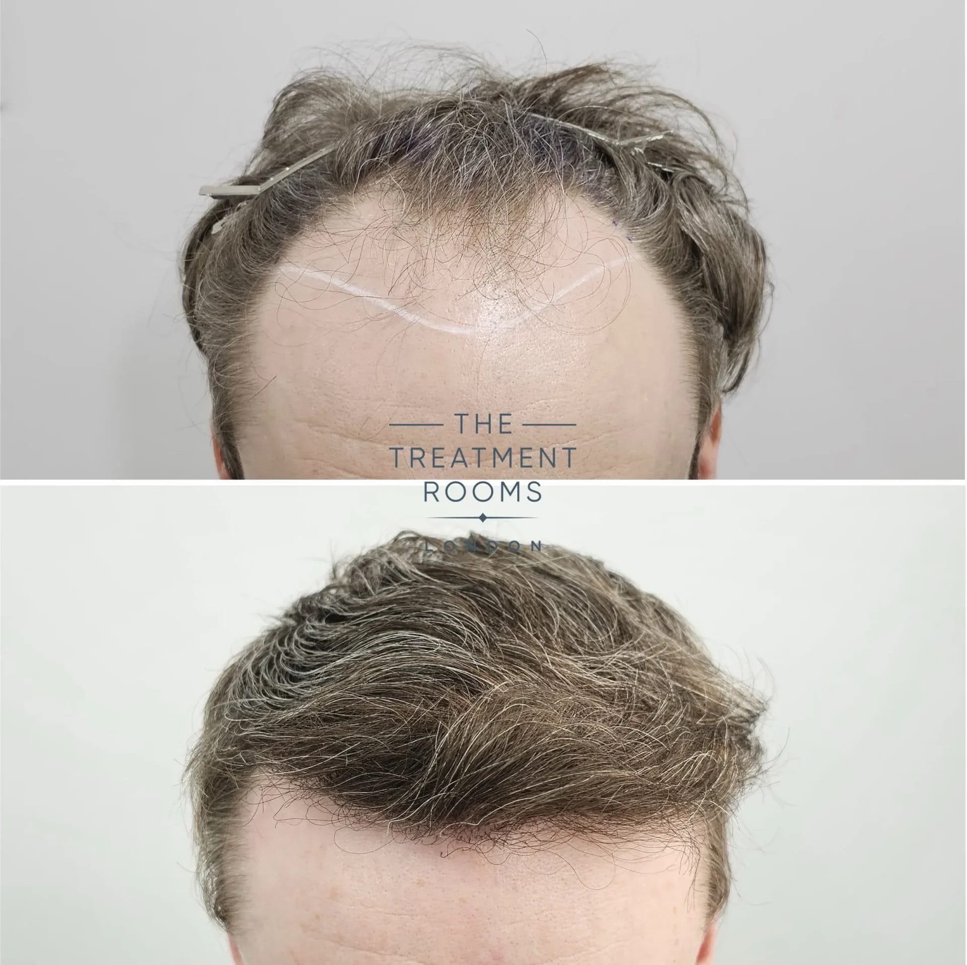 hairline transplant london before and after 2069 grafts