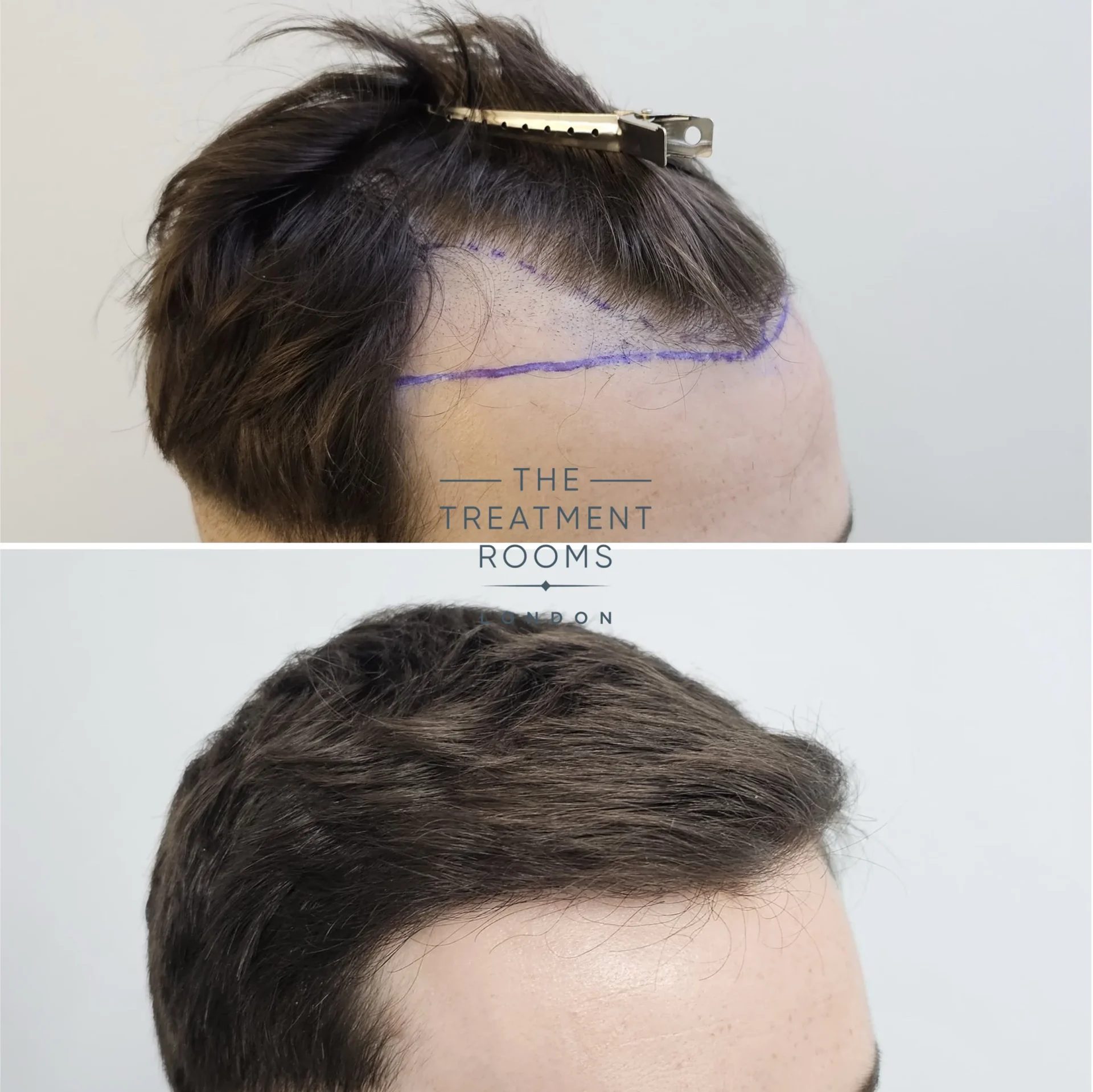 hairline transplant london before and after 869 grafts